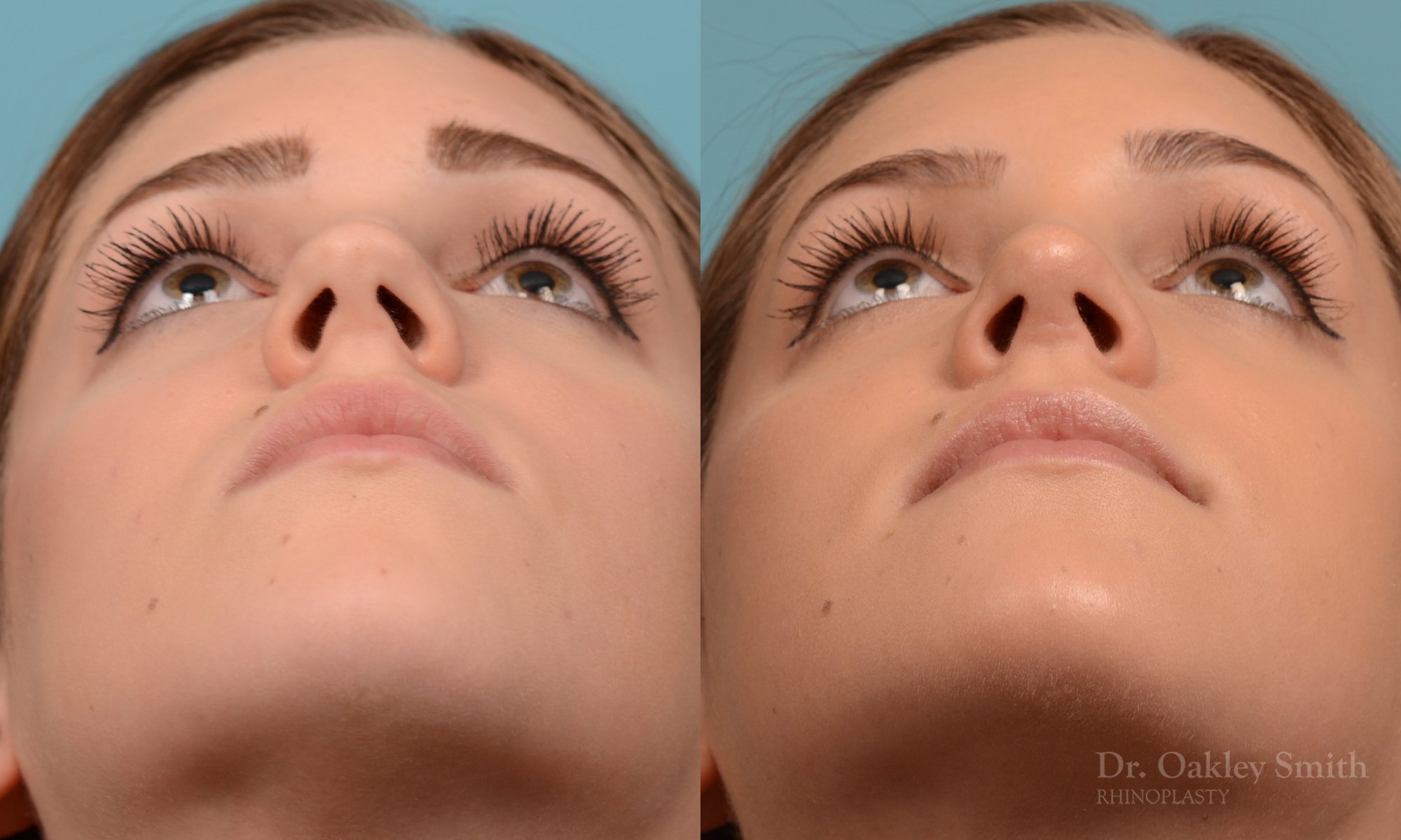 293F-rhinoplasty-dr-oakley-smith-toronto-nose-job.jpg