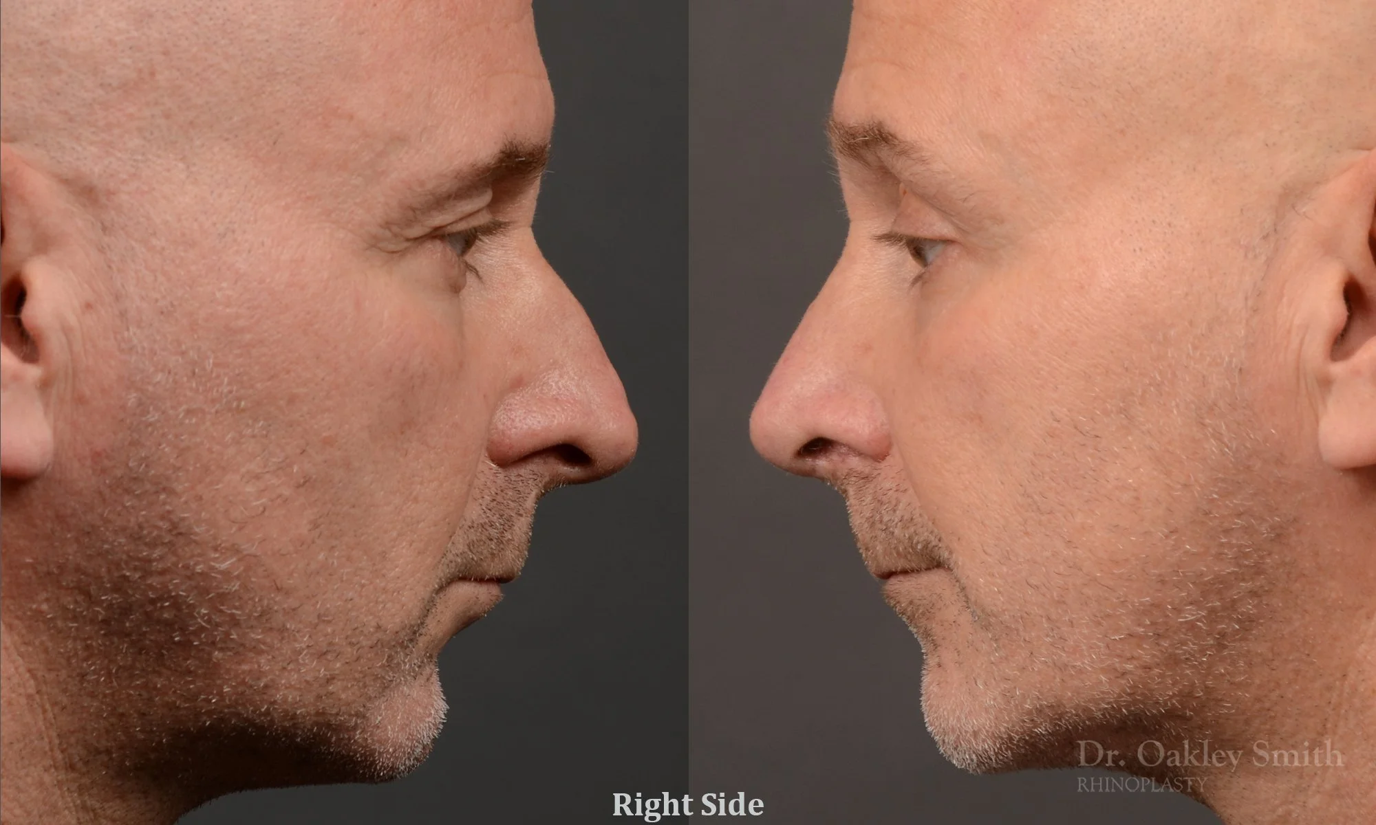 493: Primary Male Rhinoplasty, Normal Skin, Bridge Work, Tip Work