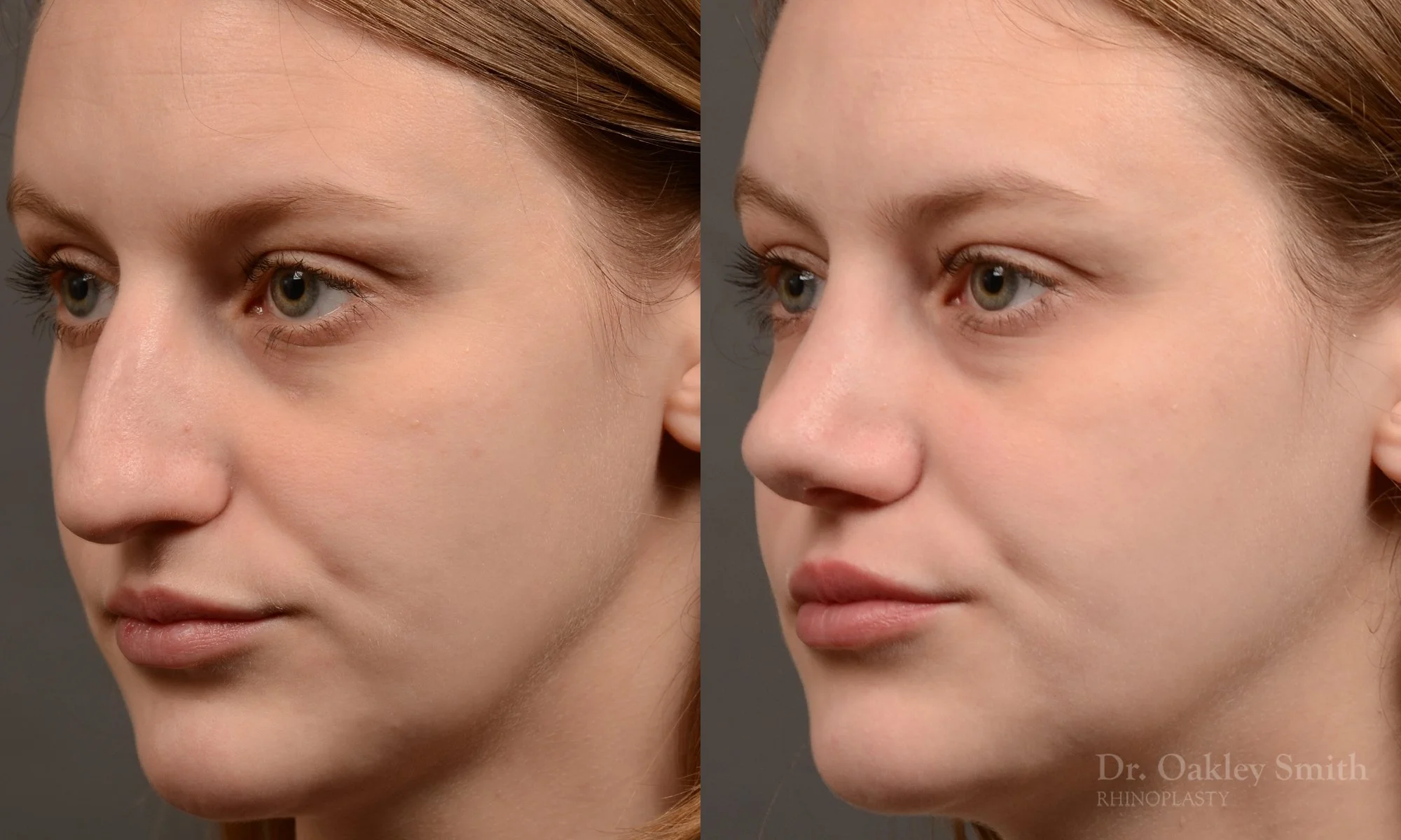 539D-rhinoplasty-dr-oakley-smith-toronto-nose-job.jpg