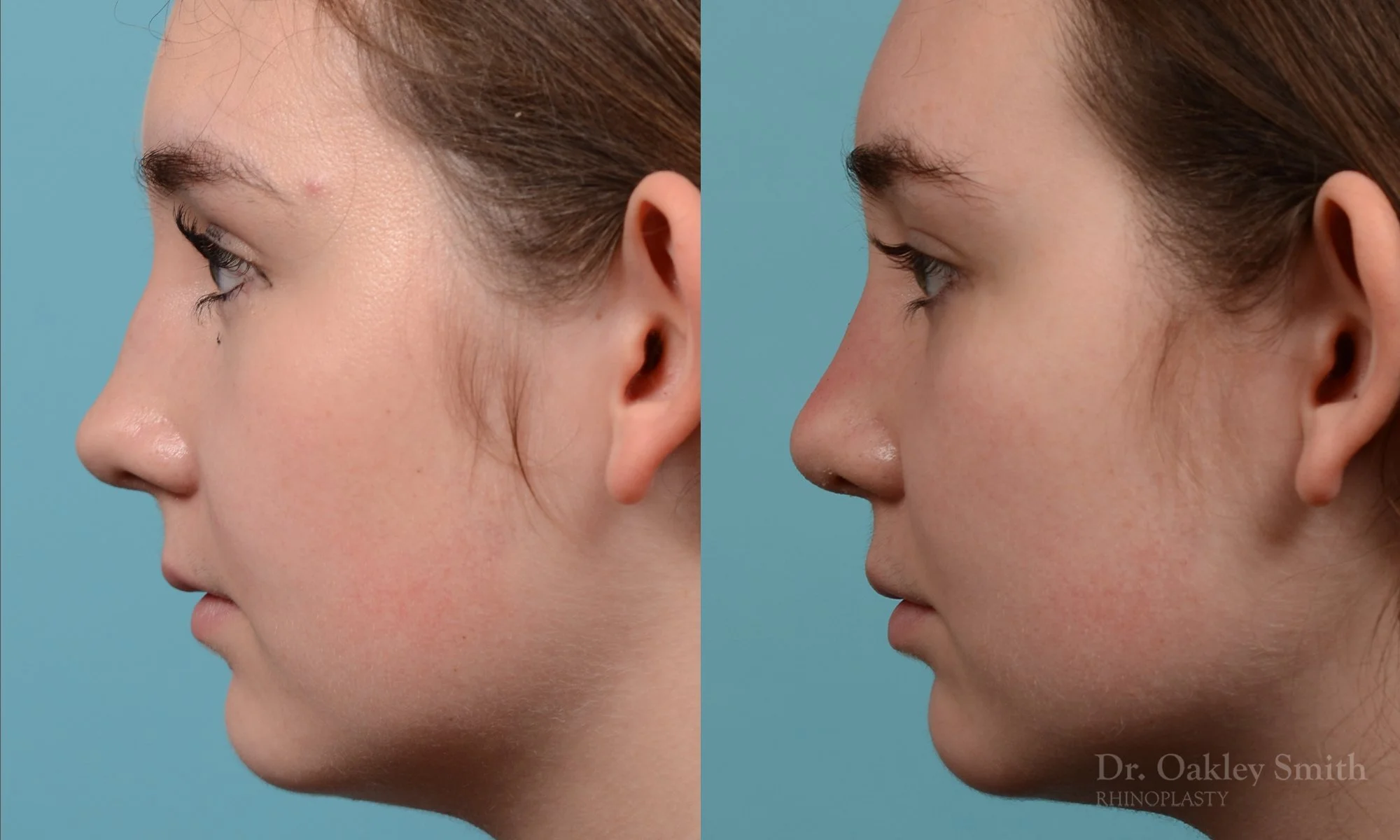 264E-rhinoplasty-dr-oakley-smith-toronto-nose-job.jpg