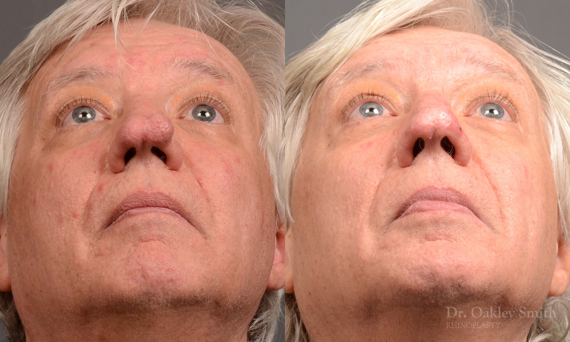 532.1F-Rhinophyma-nose-job-growth-toronto-nose-surgeon-dr.jpg