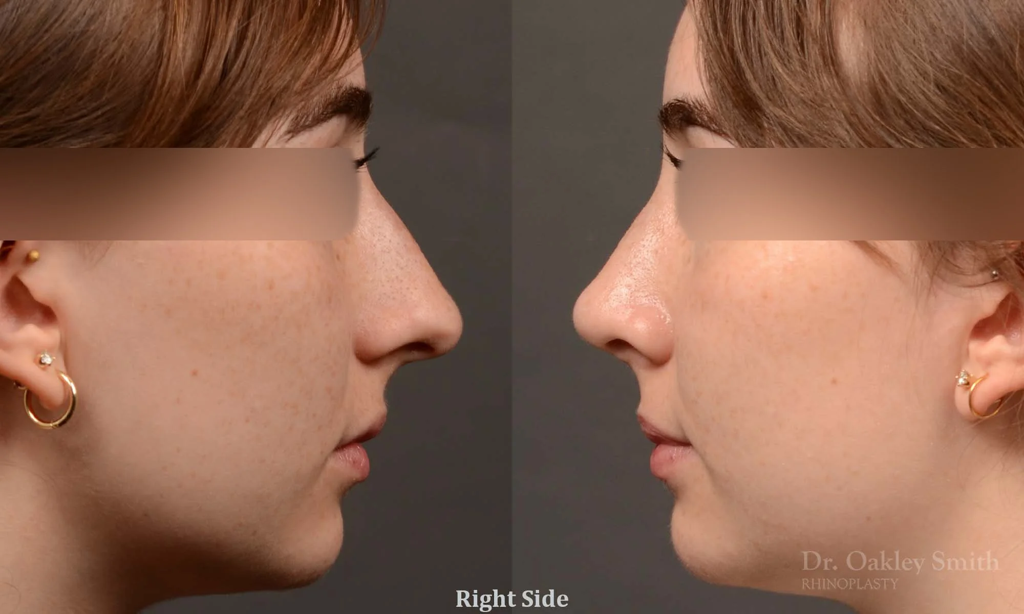 551C-rhinoplasty-nose-job-toronto-nose-surgeon-dr-oakley-smith.jpg