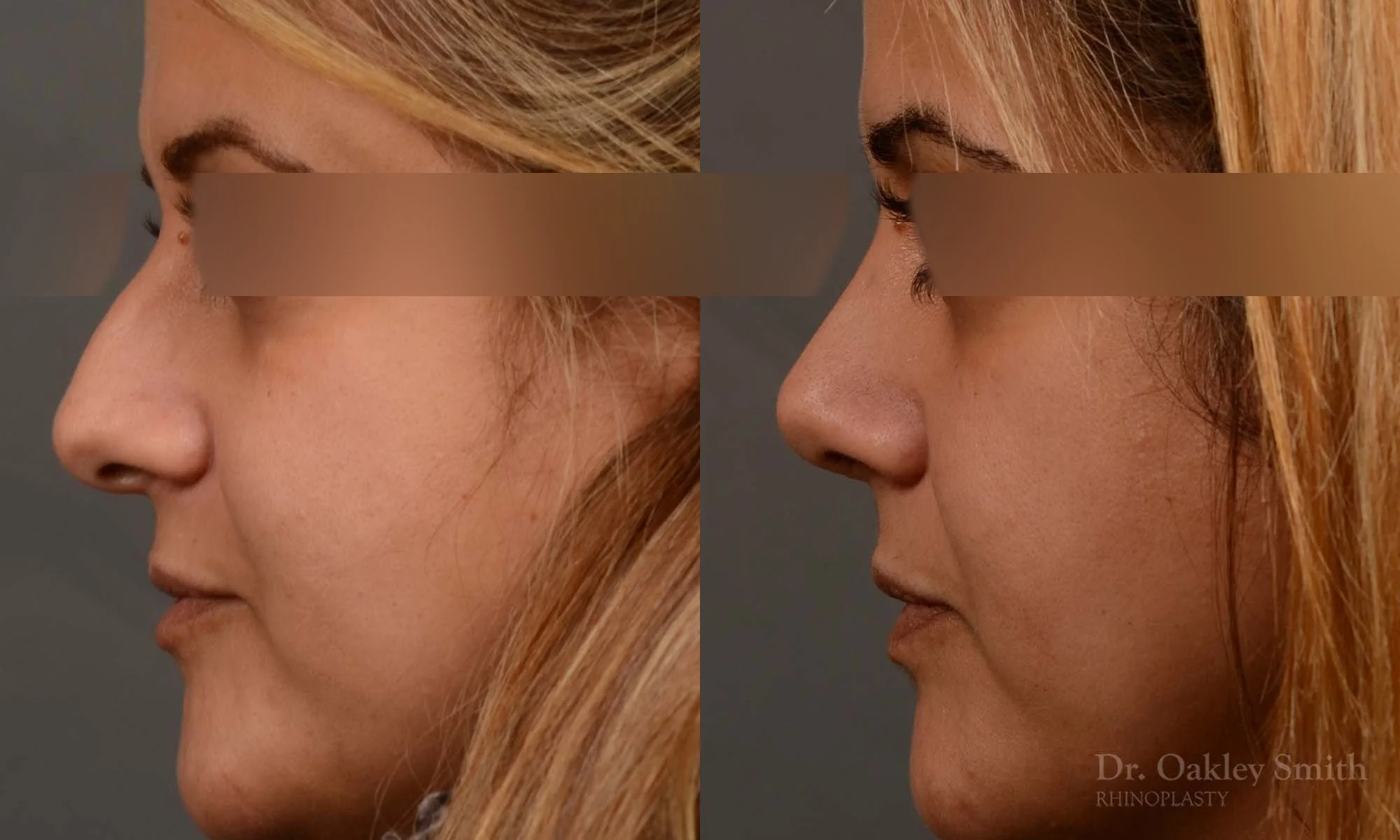 527E-rhinoplasty-dr-oakley-smith-toronto-top-surgeon-nose-job.jpg