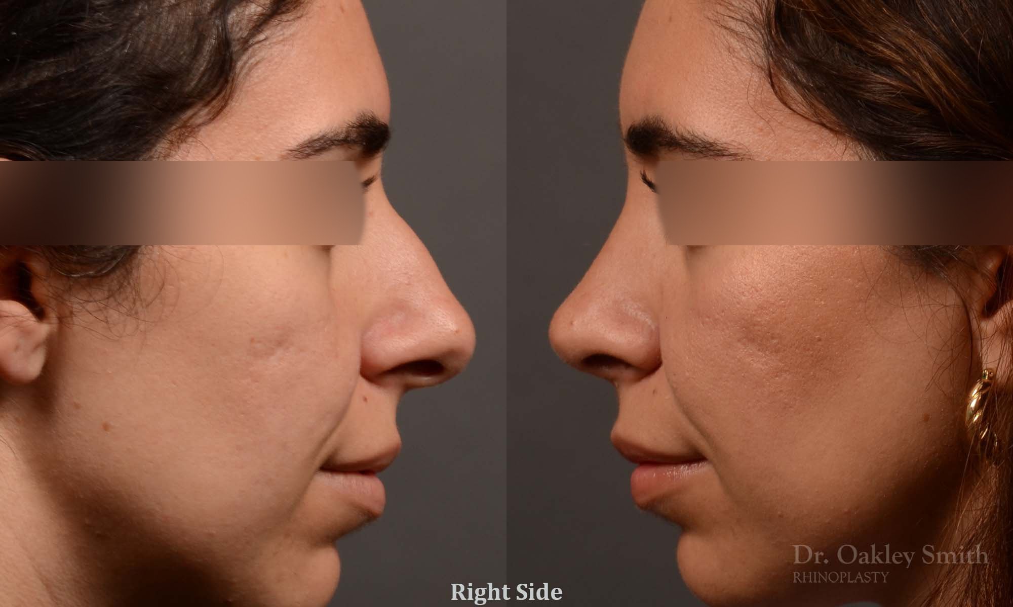 488: Female, Primary  Rhinoplasty, Normal Skin, Bridge Work, Tip Work