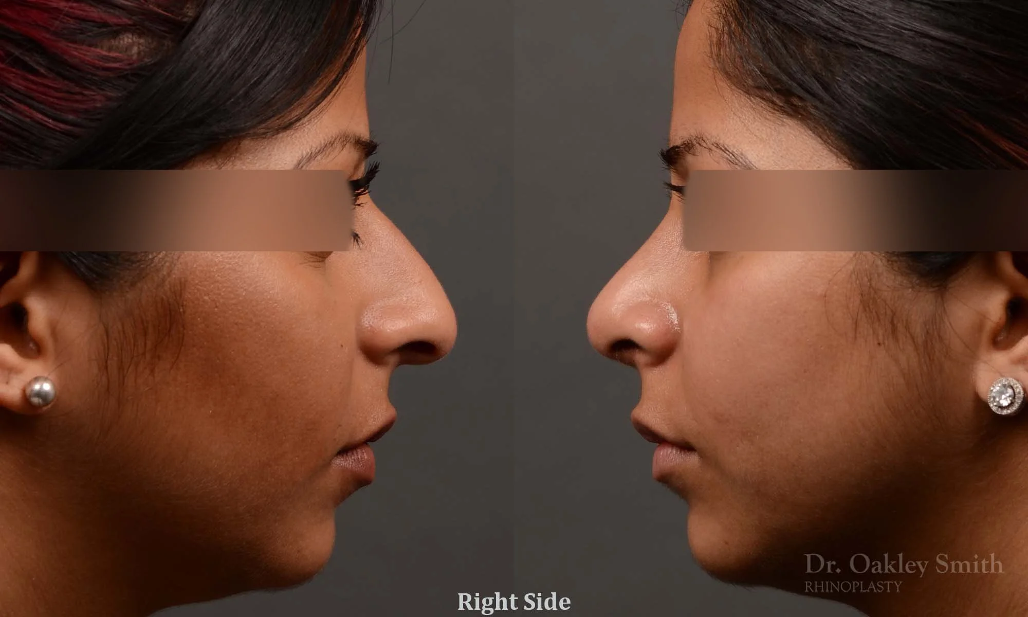 346C-rhinoplasty-dr-oakley-smith-toronto-nose-job.jpg