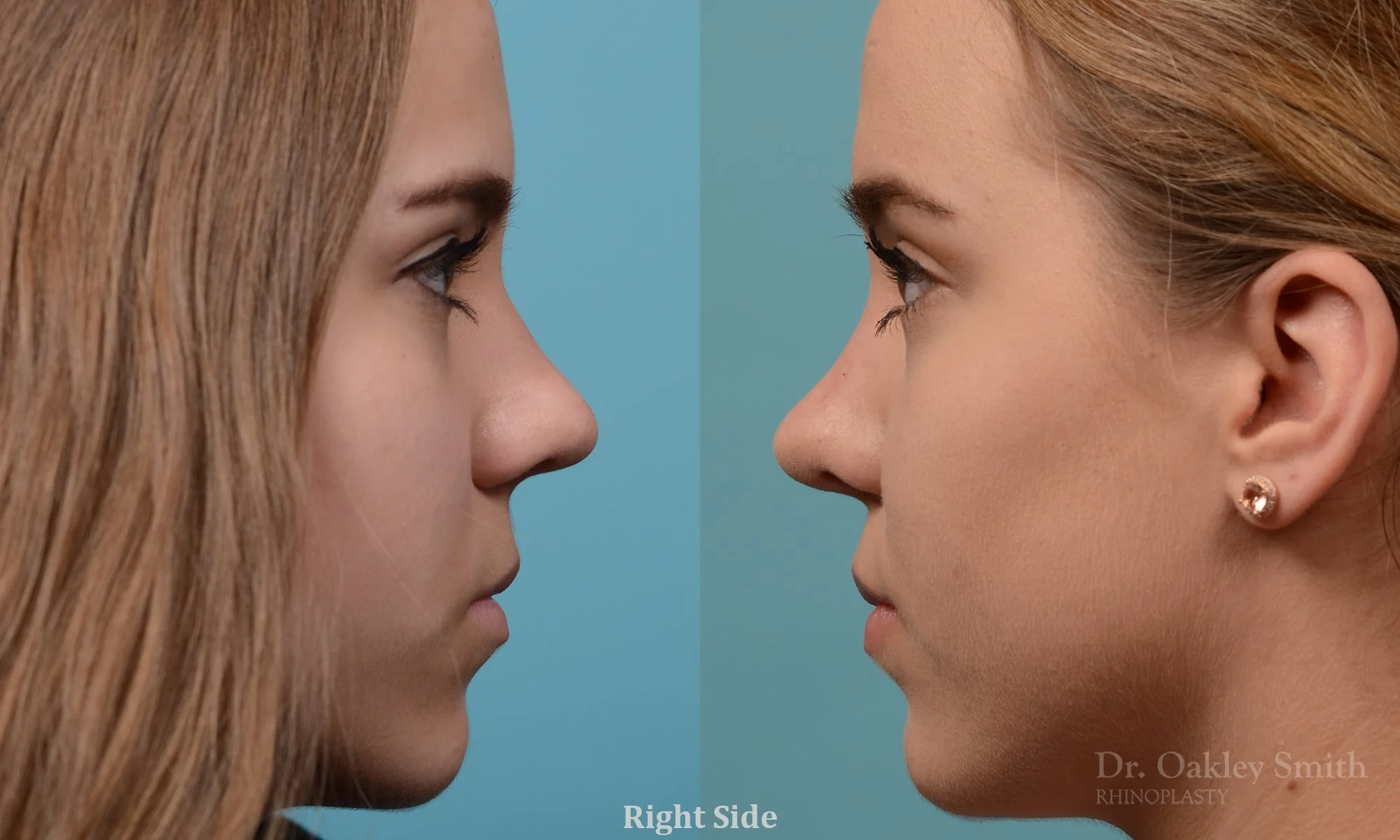 355C-rhinoplasty-dr-oakley-smith-toronto-nose-job.jpg