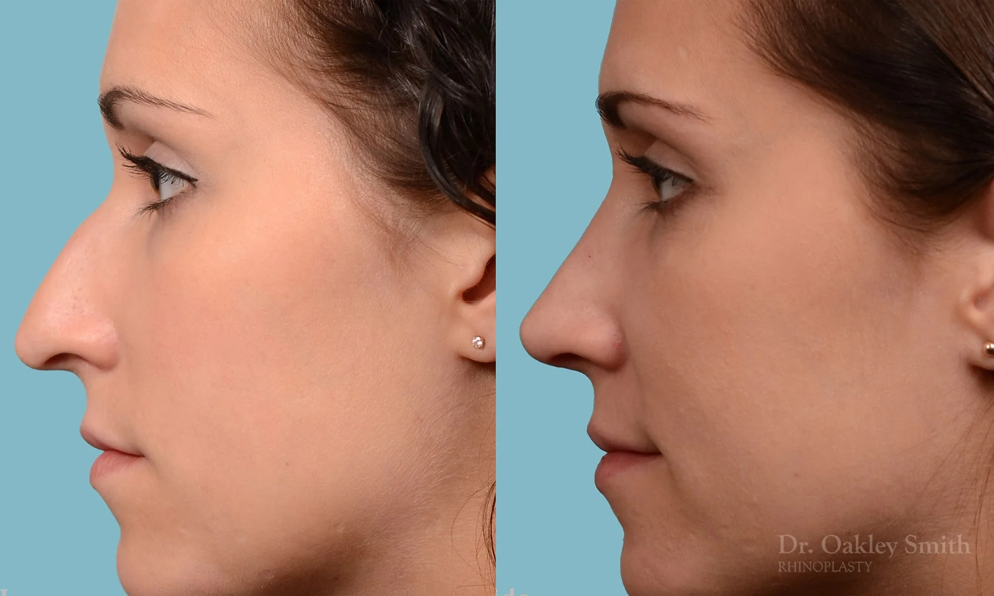 224E-rhinoplasty-nose-job-dr-oakley-smith-toronto-long-nose-large-nose-straight-nose-bridge-1.jpg