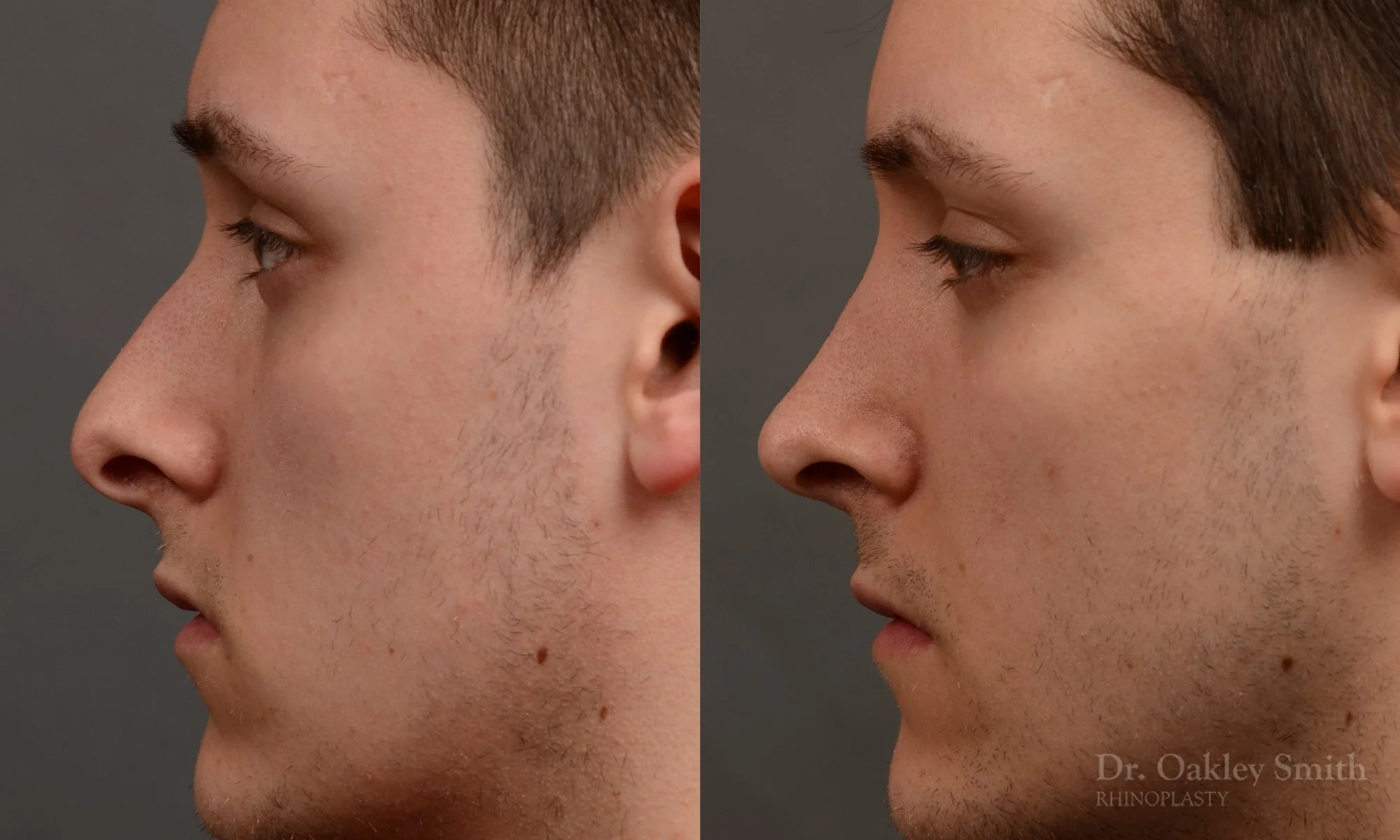 377.1E-rhinoplasty-dr-oakley-smith-toronto-nose-job.jpg