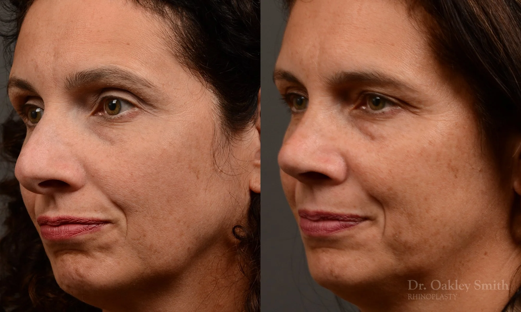 545D-rhinoplasty-nose-job-top-toronto-surgeon-dr.-oakley-smith.jpg