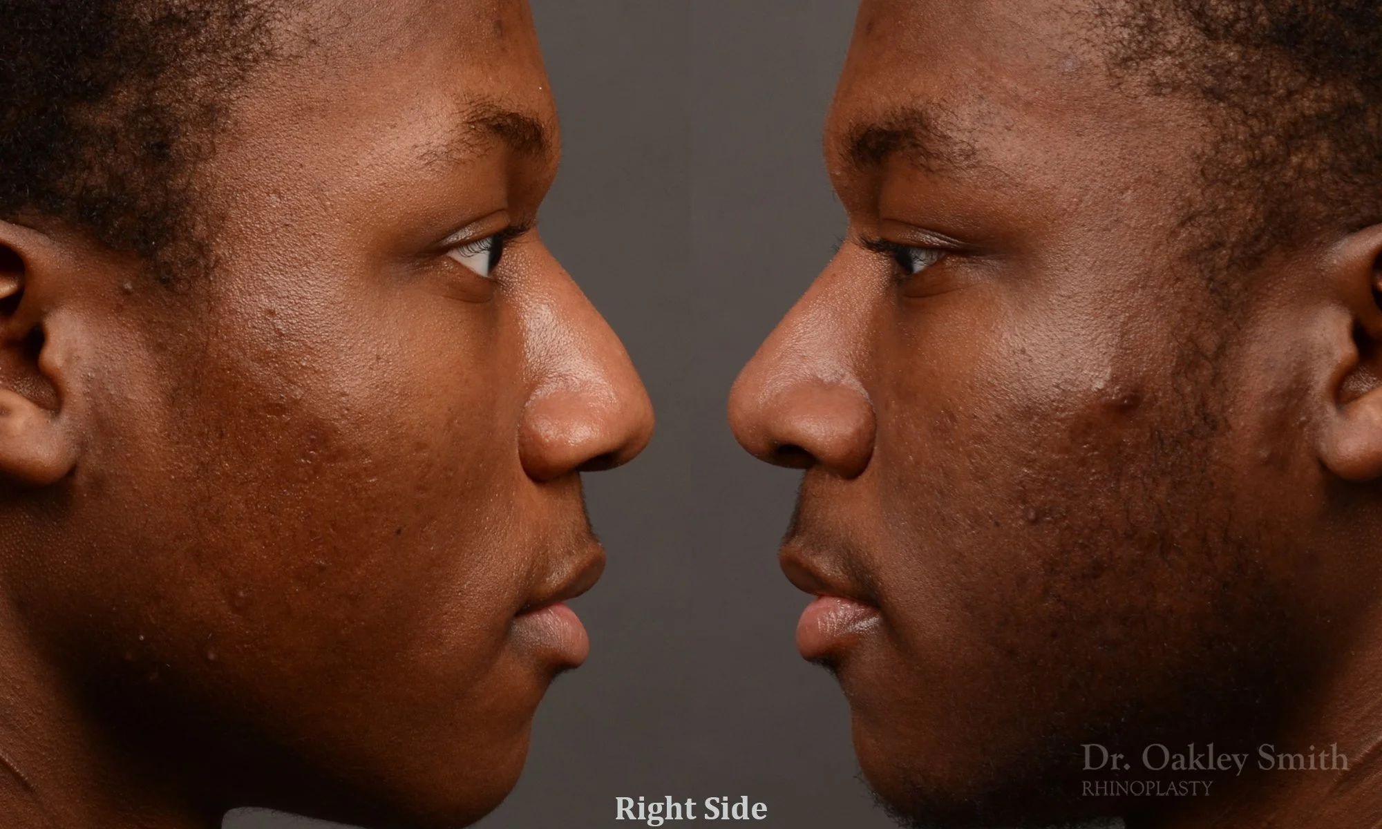 515C-male-rhinoplasty-dr-oakley-smith-toronto-top-surgeon-nose-job (1).jpg