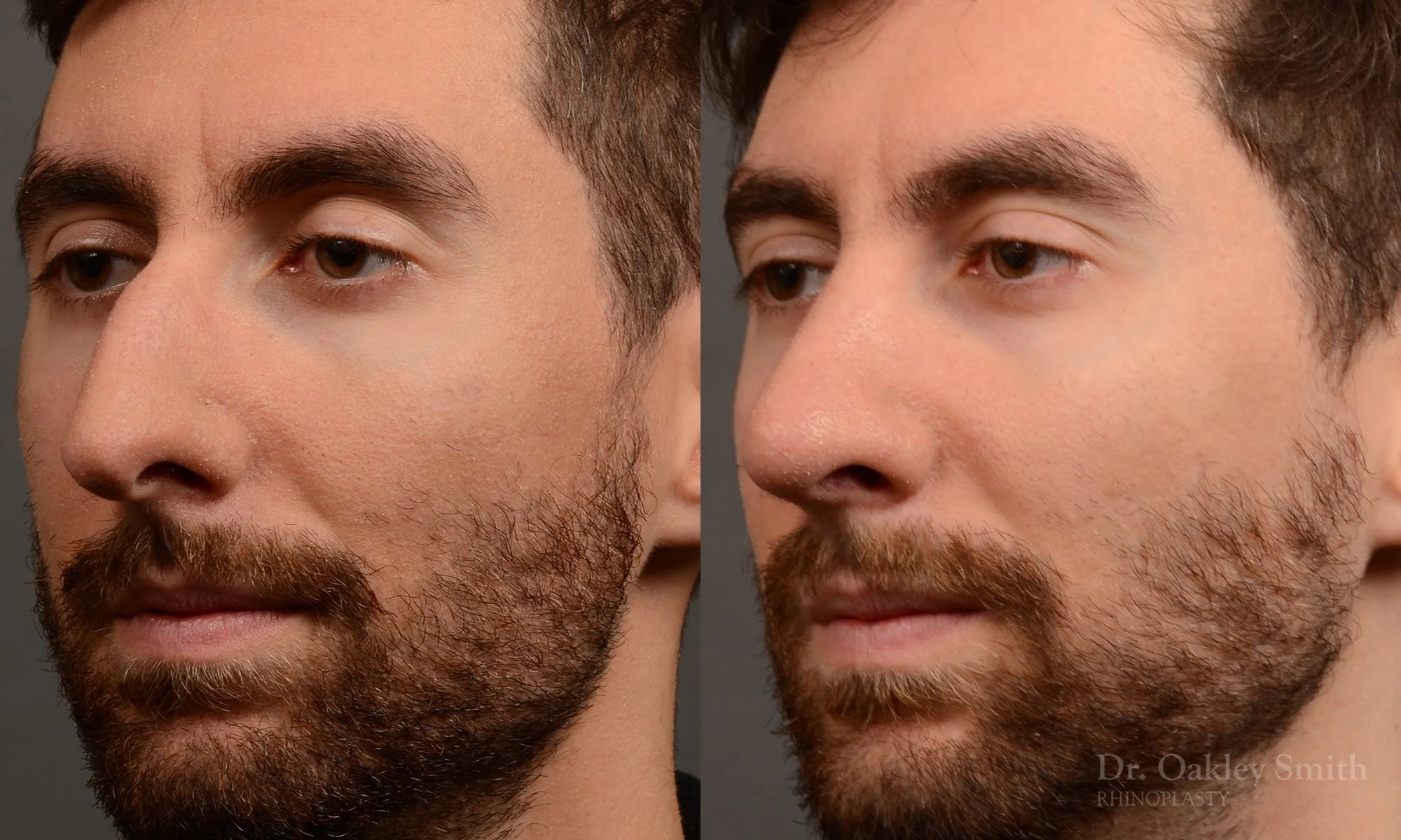 469D-rhinoplasty-dr-oakley-smith-toronto-top-surgeon-nose-job.jpg