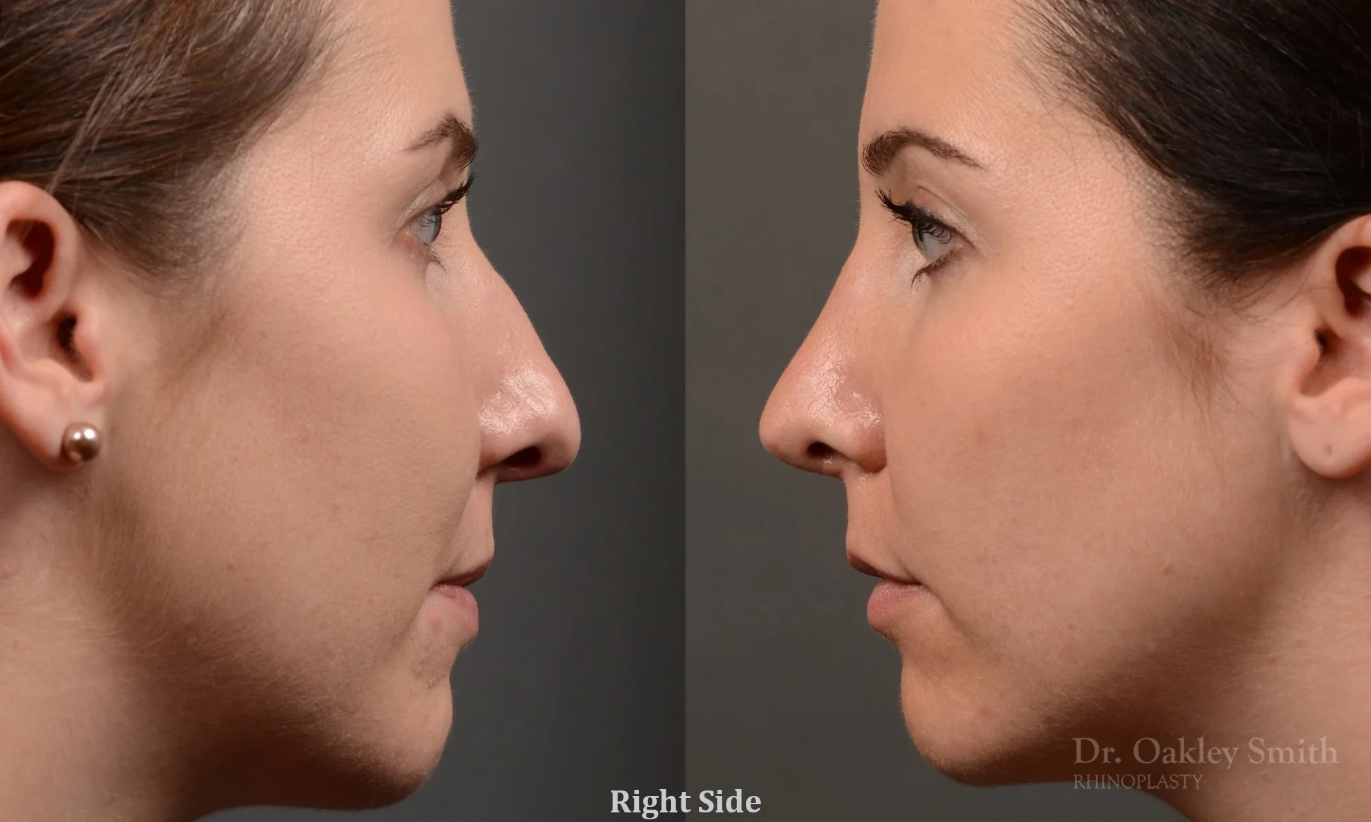 357: Female, Primary Rhinoplasty, Dorsal Bump, Tip Rotation
