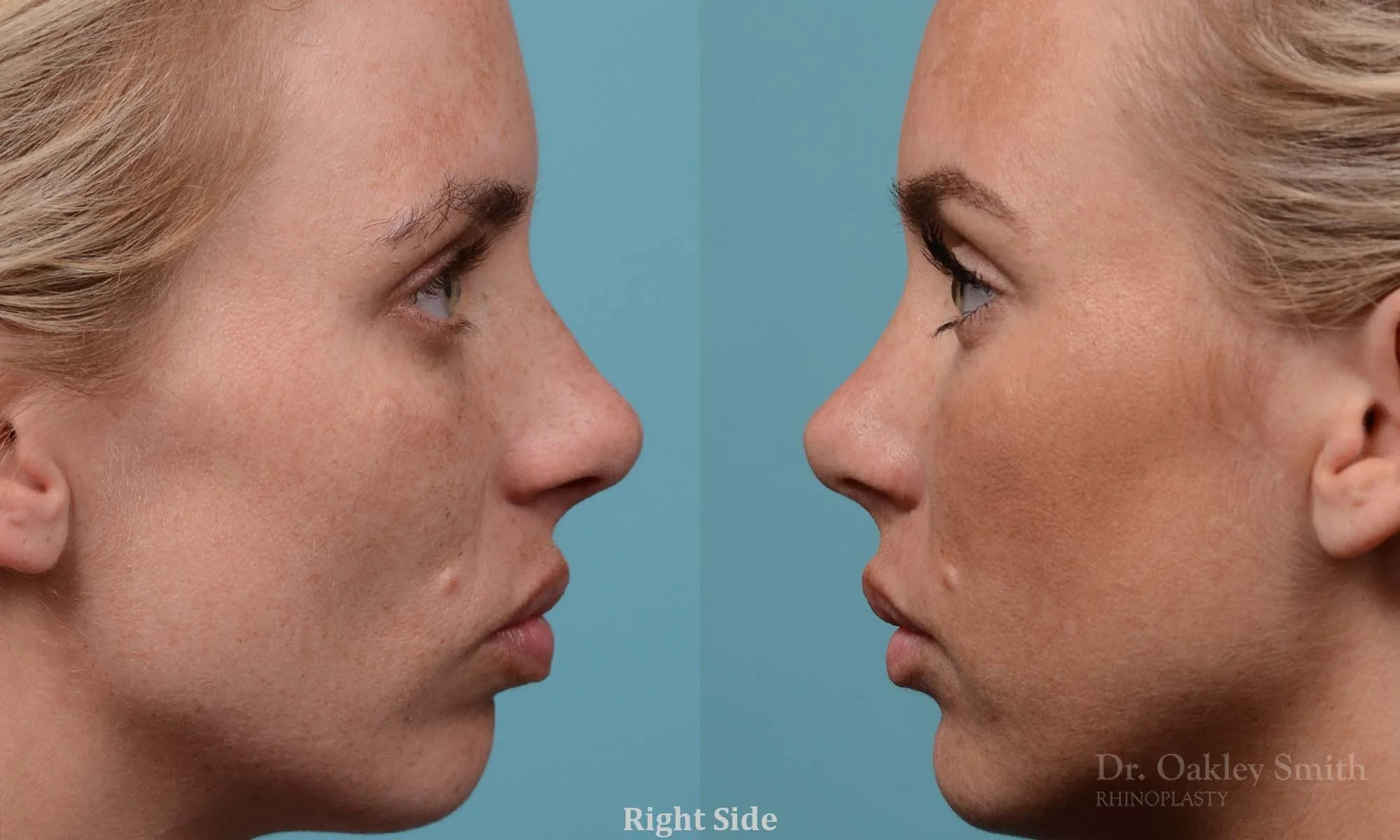 284C-rhinoplasty-dr-oakley-smith-toronto-nose-job.jpg
