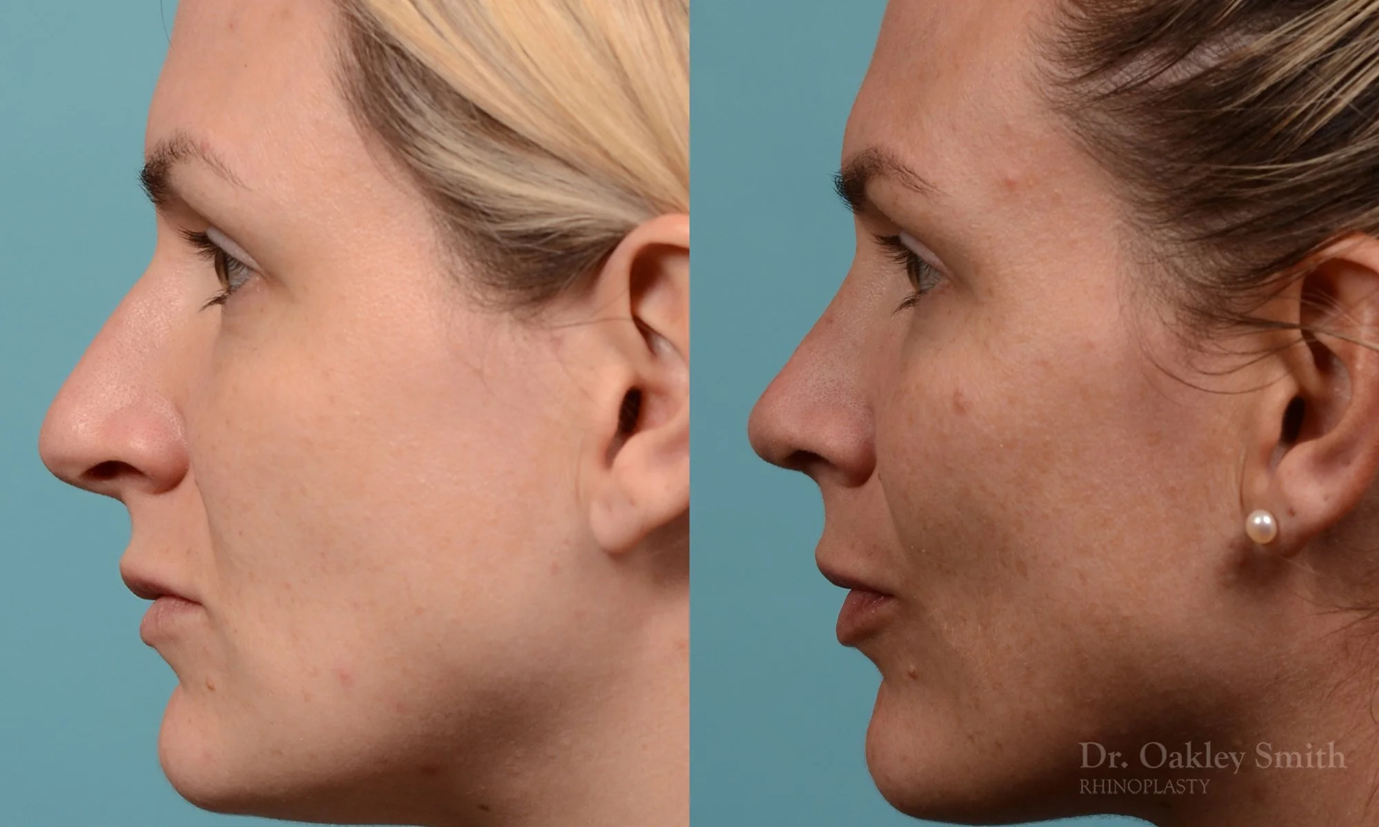 312E-rhinoplasty-dr-oakley-smith-toronto-nose-job.jpg