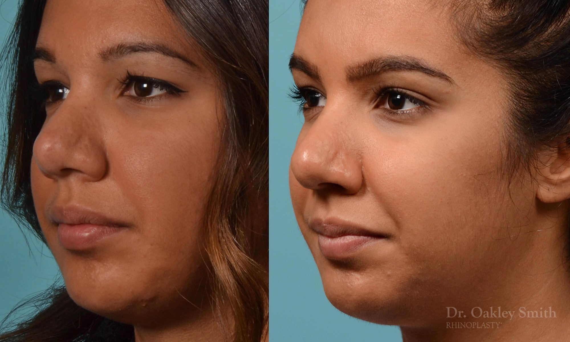 237D-rhinoplasty-dr-oakley-smith-1-1.jpg