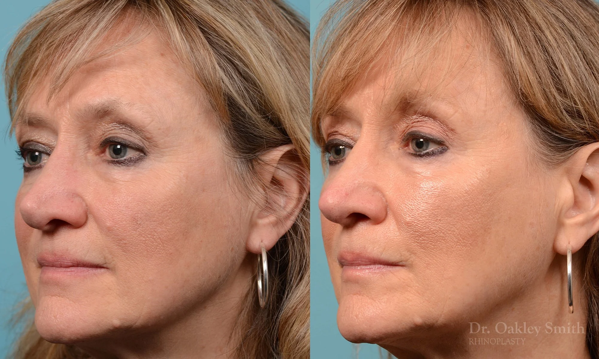 225D-rhinoplasty-dr-oakley-smith-nose-job-curved-nose-columellar-long-nose-1.jpg