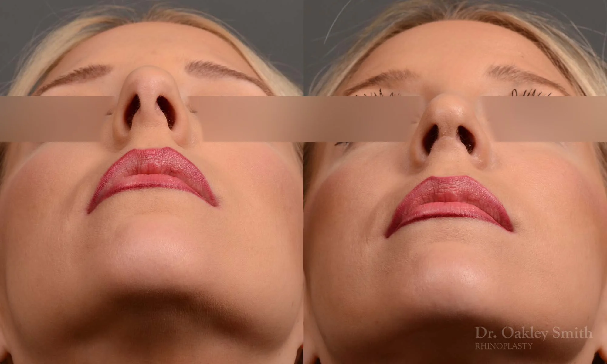 307F-rhinoplasty-dr-oakley-smith-nose-job-toronto.jpg