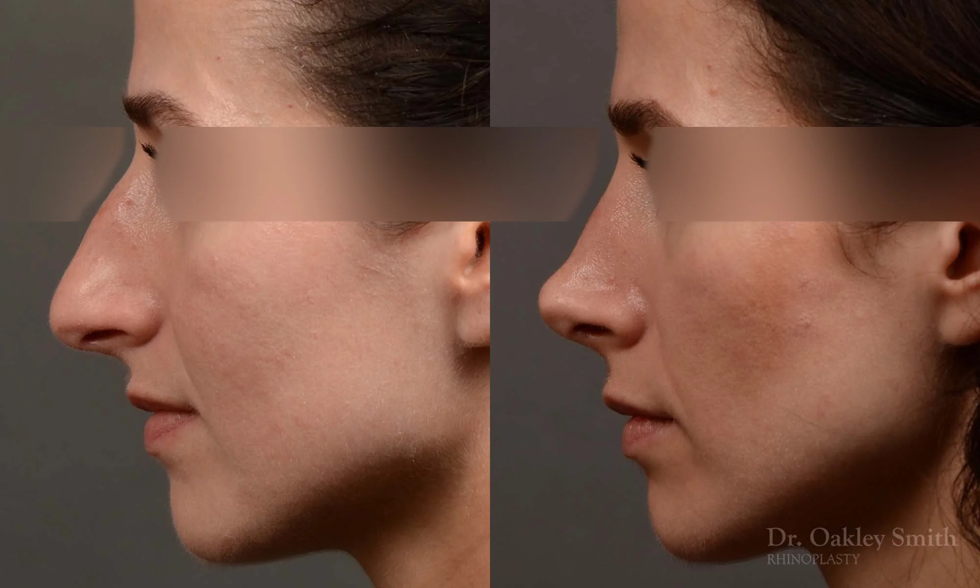 529BErhinoplasty-dr-oakley-smith-toronto-top-surgeon-nose-job.jpg