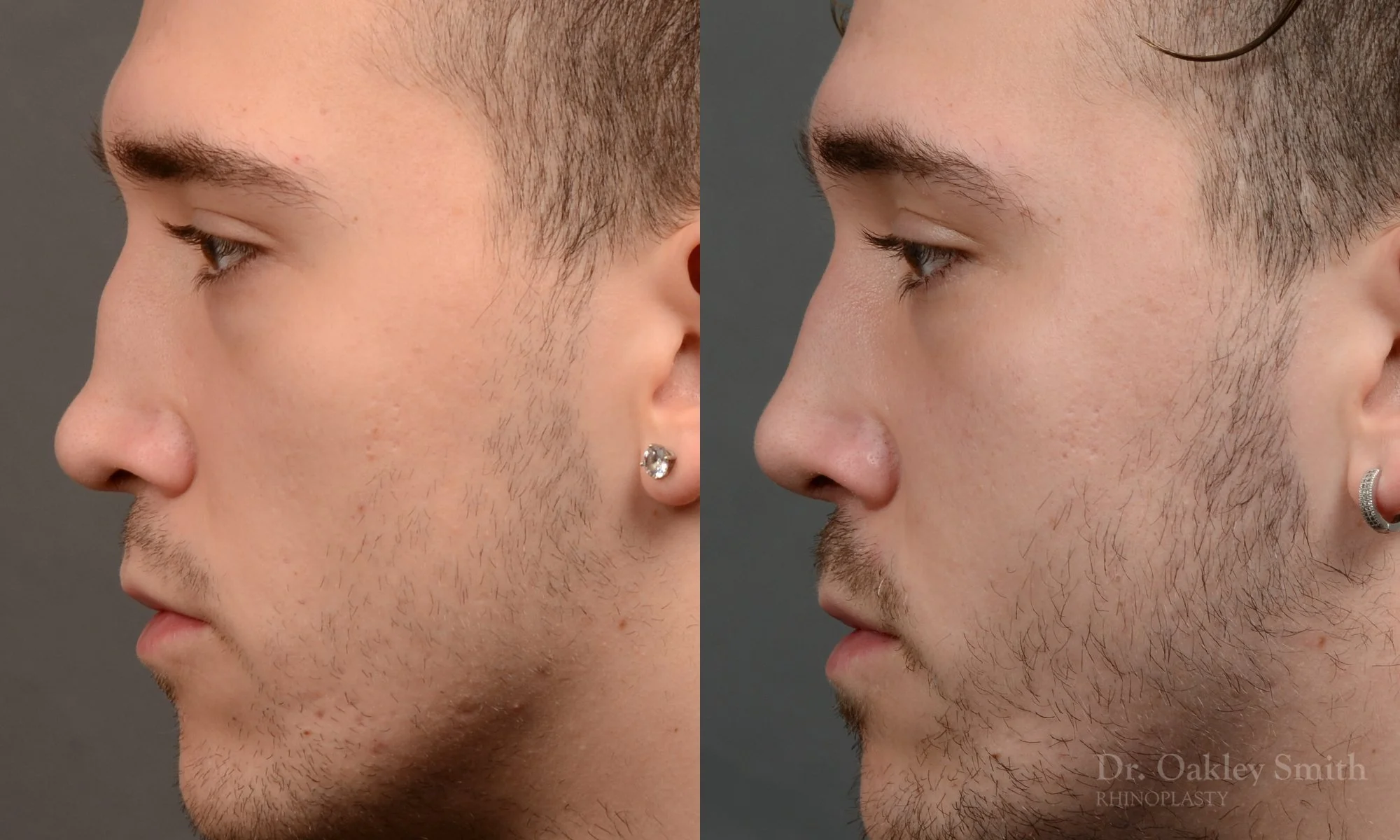 503E-male-rhinoplasty-dr-oakley-smith-toronto-top-surgeon-nose-job.jpg