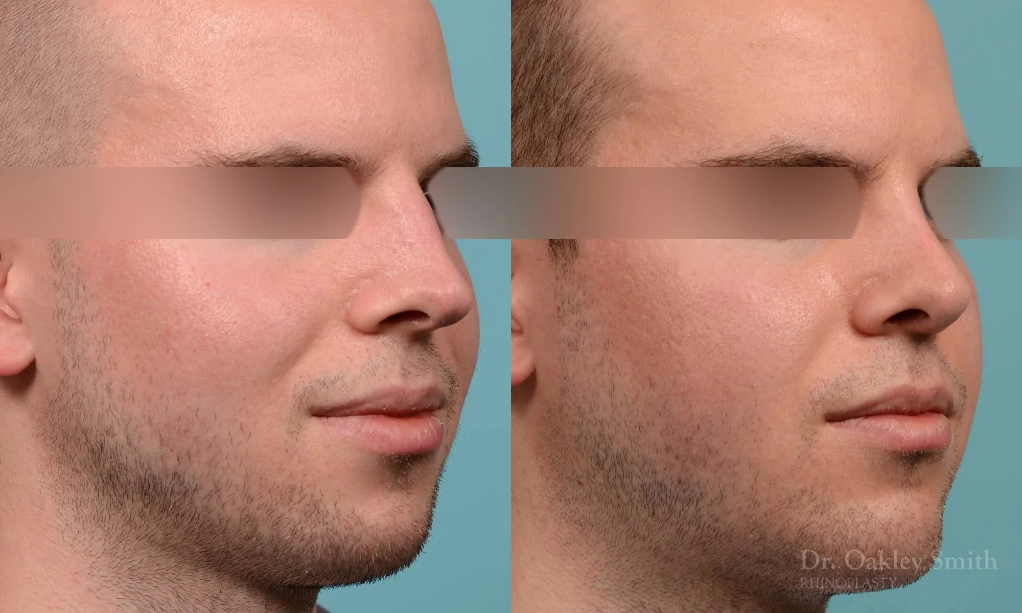 278B-rhinoplasty-dr-oakley-smith-toronto-male-nose-job.jpg