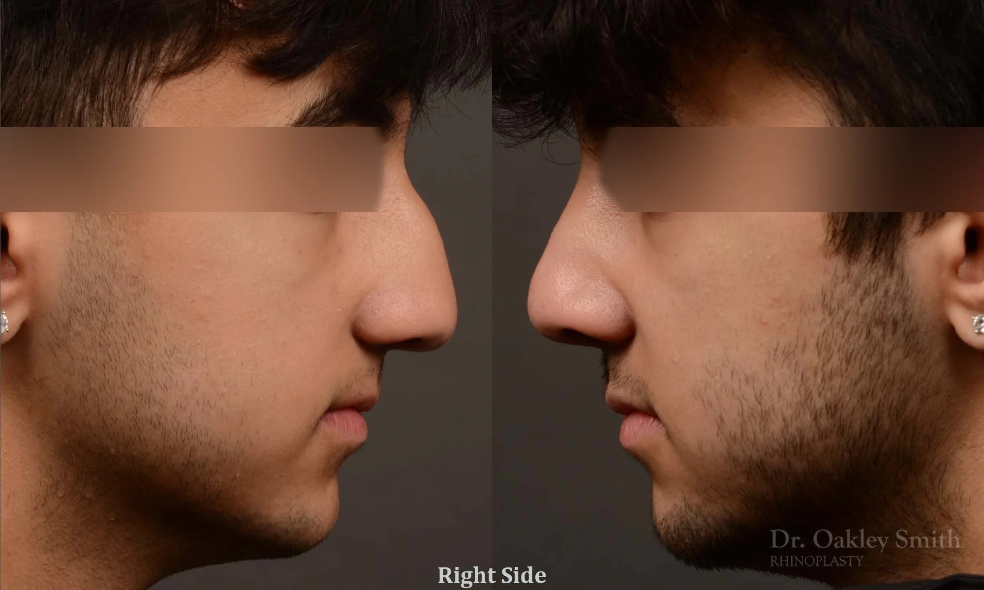520: Primary Male Rhinoplasty, Normal Skin, Bridge Work, Tip Work