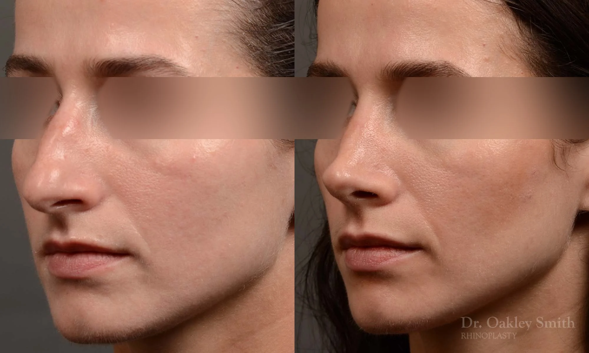 529D-rhinoplasty-dr-oakley-smith-toronto-top-surgeon-nose-job.jpg