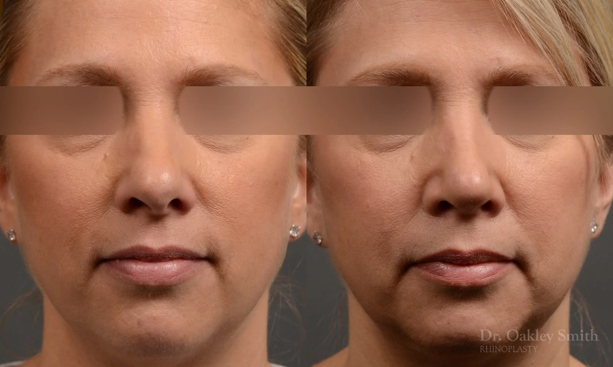344A-rhinoplasty-dr-oakley-smith-toronto-nose-job-1.jpg