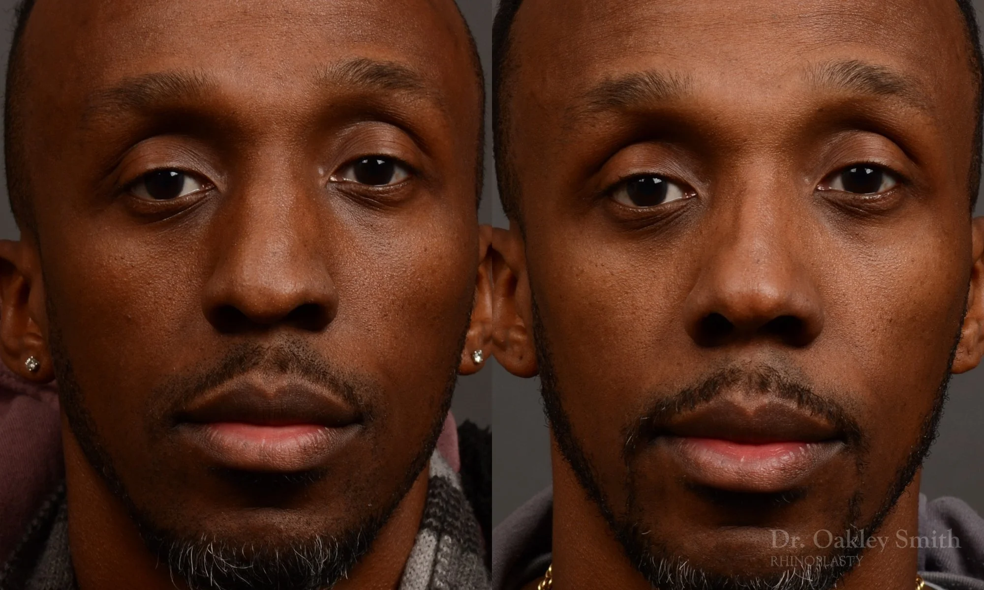504A-malerhinoplasty-dr-oakley-smith-toronto-top-surgeon-nose-job.jpg
