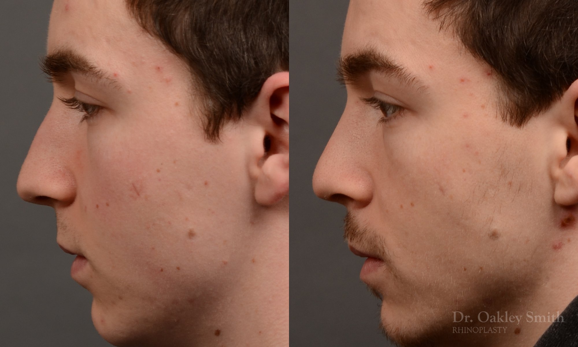 403E-male-rhinoplasty-dr-oakley-smith-toronto-nose-job.jpg