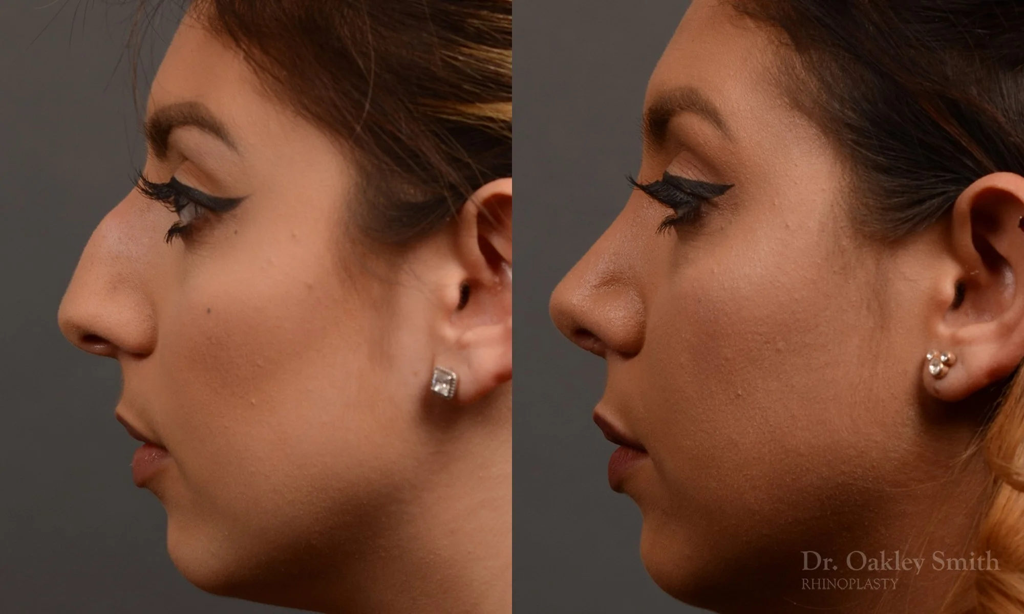 350E-rhinoplasty-dr-oakley-smith-toronto-nose-job (1).jpg