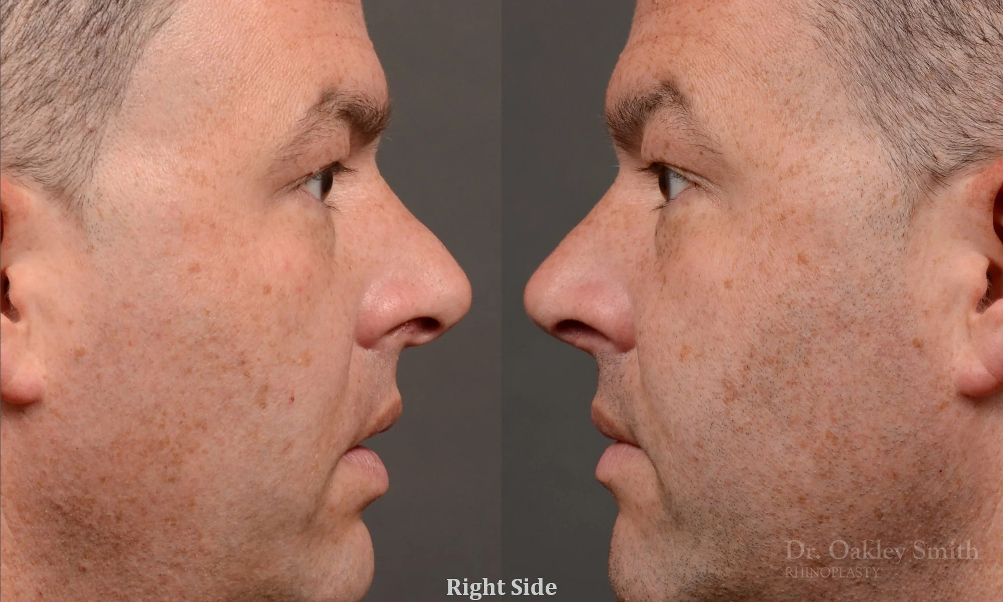 514: Primary Male Rhinoplasty, Normal Skin, Bridge Work, Tip Work