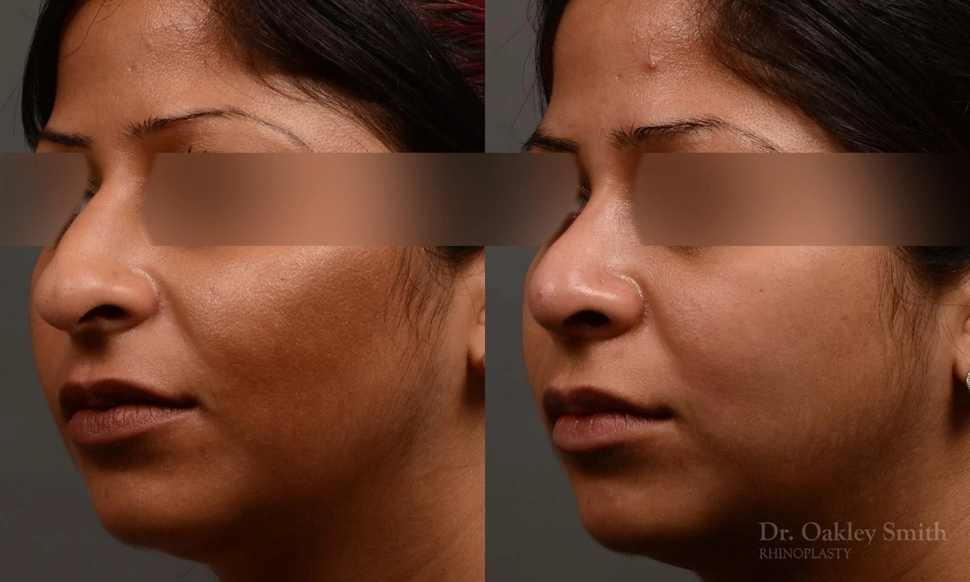 346D-rhinoplasty-dr-oakley-smith-toronto-nose-job.jpg