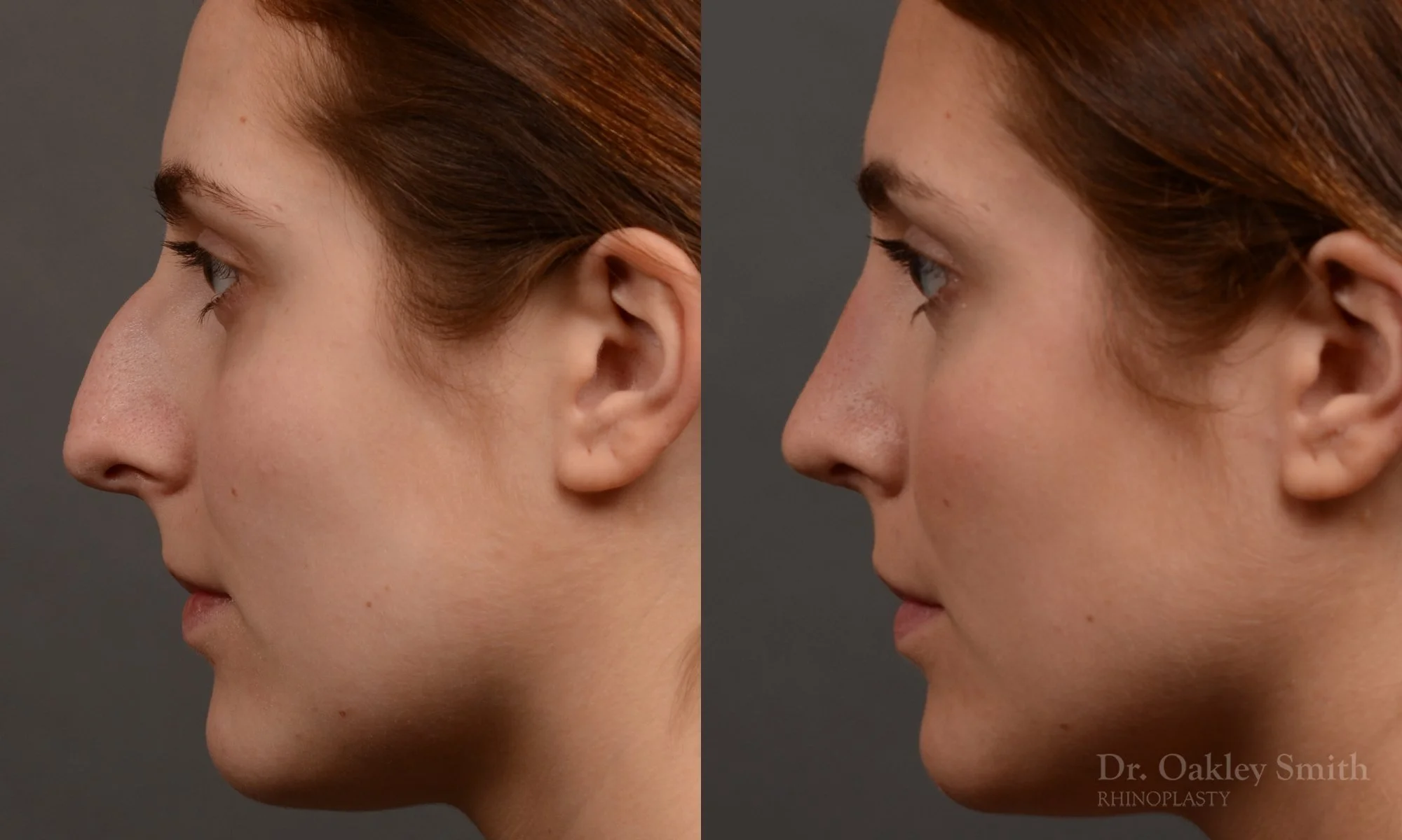 305E-rhinoplasty-dr-oakley-smith-toronto-nose-job.jpg