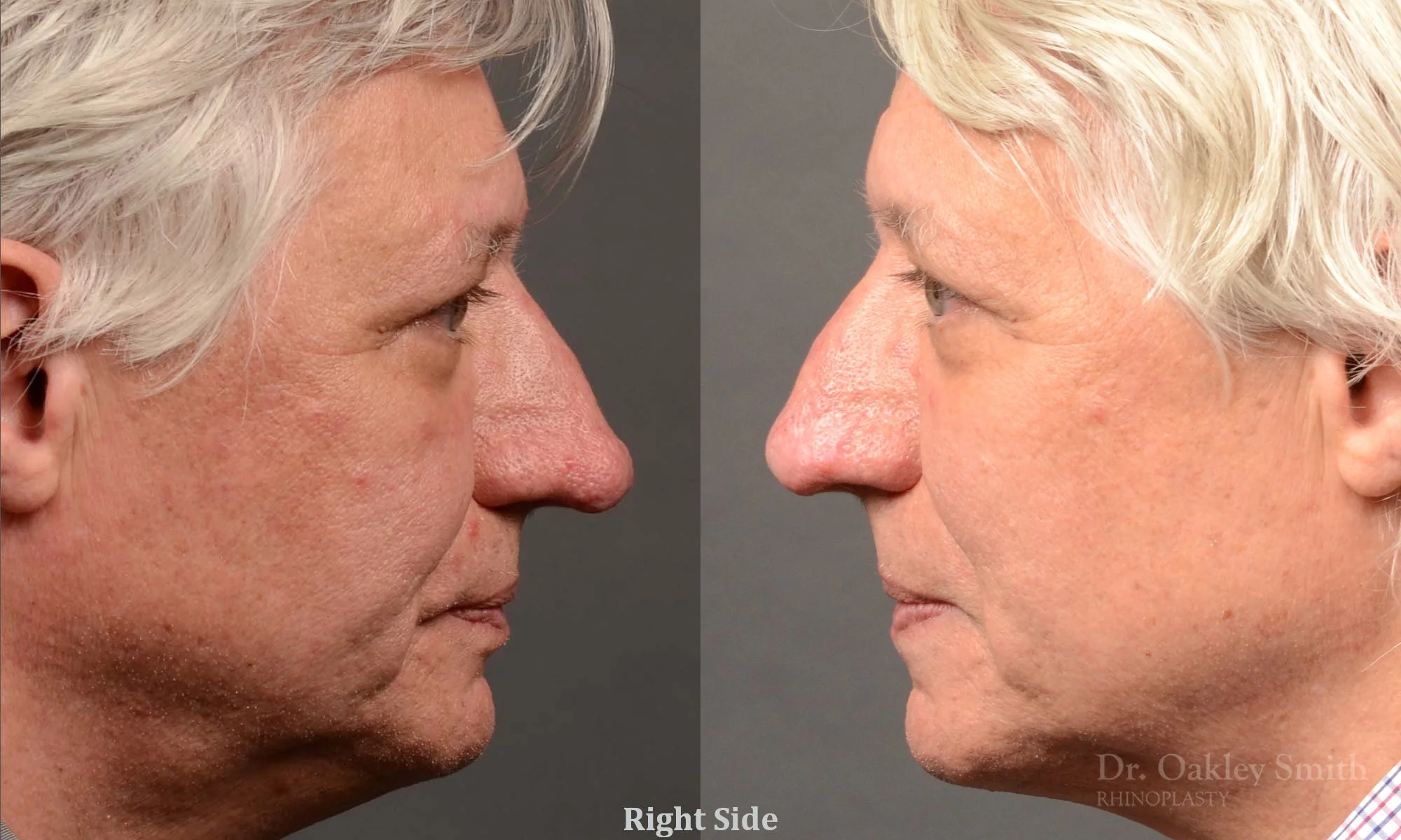 532.1C-Rhinophyma-nose-job-growth-toronto-nose-surgeon-dr-oakley-smith.jpg