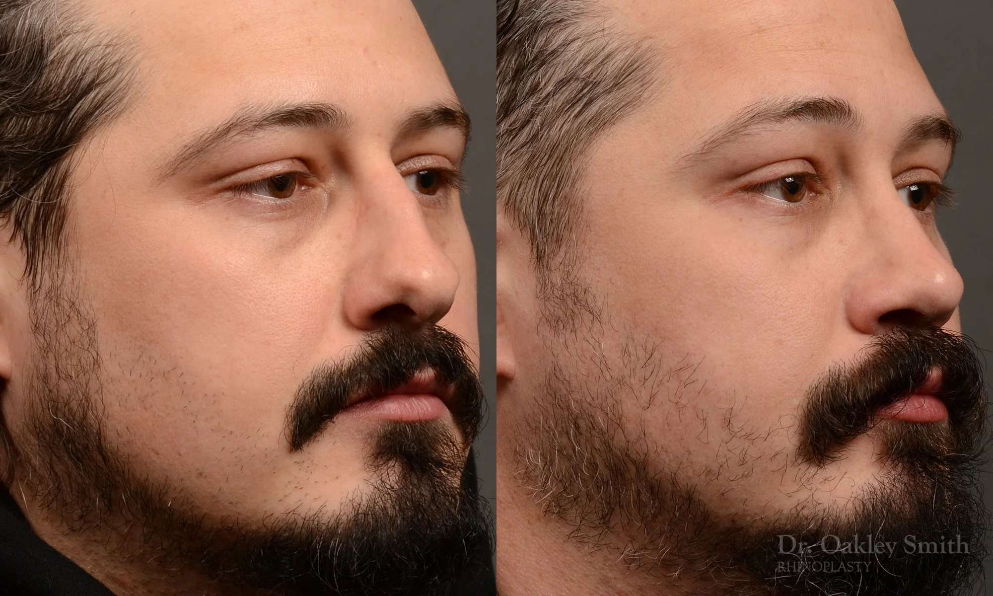 501B-male-rhinoplasty-dr-oakley-smith-toronto-top-surgeon-nose-job.jpg