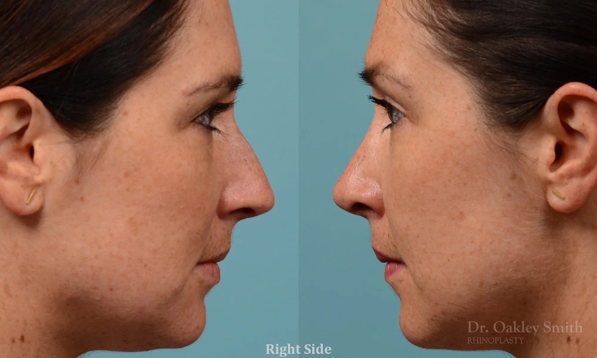 302: Female Rhinoplasty, Dorsal Hump, Tip Refinement, Crooked