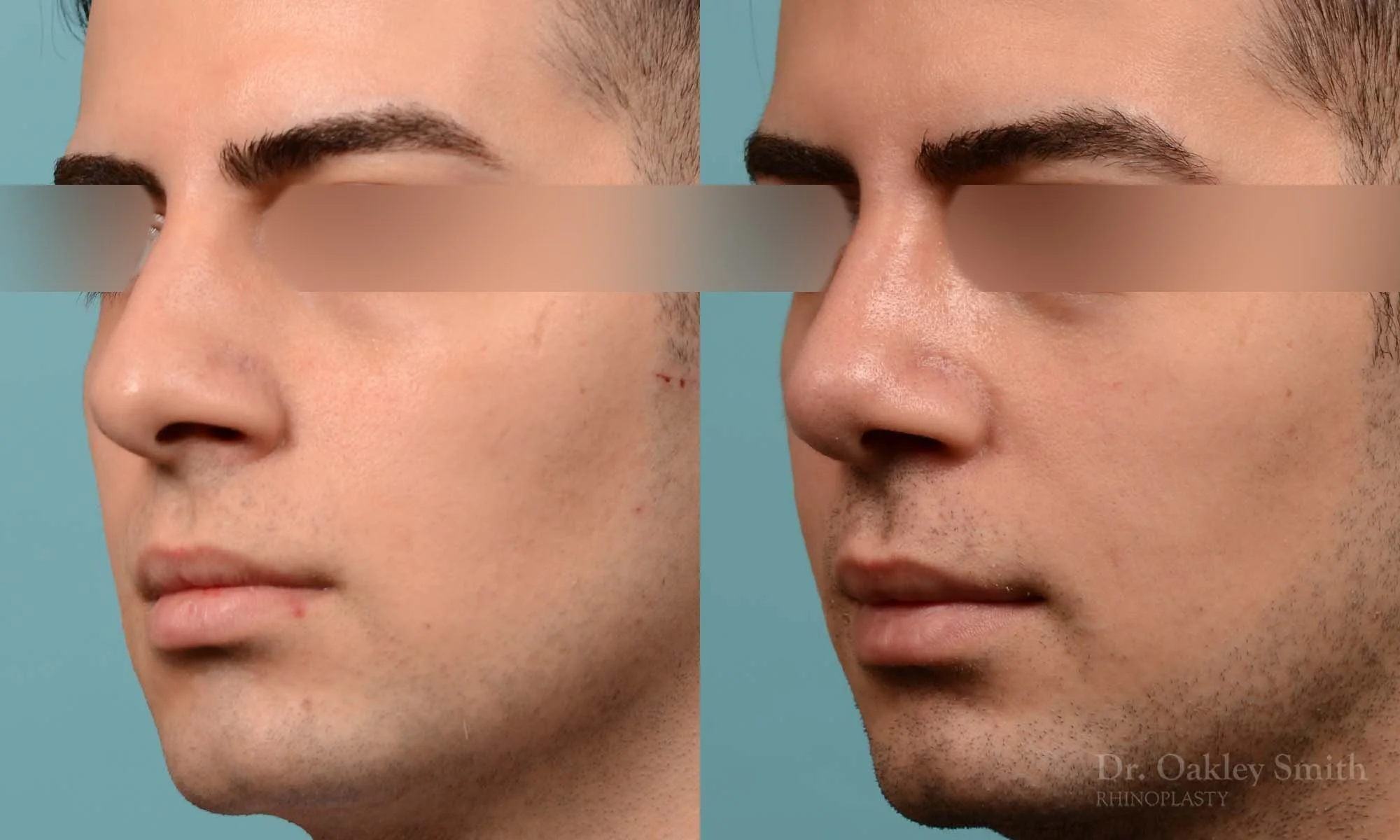 253D-rhinoplasty-dr-oakley-smith-toronto-male-nose-job.jpg