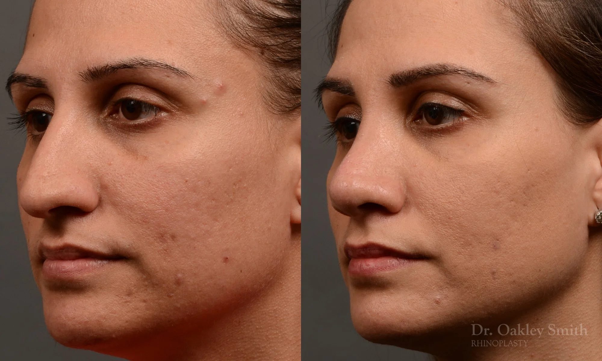 351D-rhinoplasty-dr-oakley-smith-toronto-nose-job.jpg