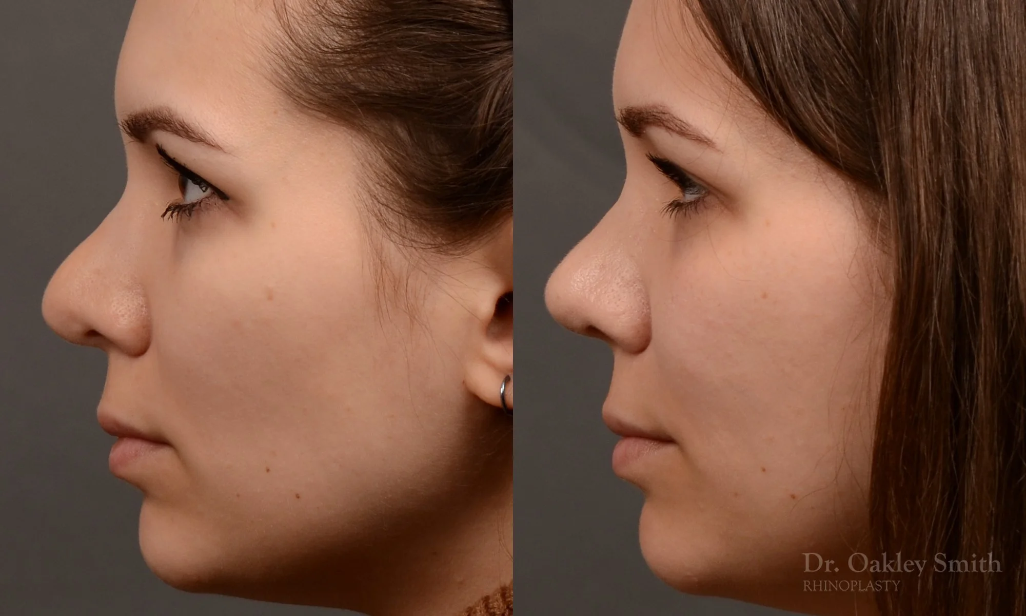 542E-rhinoplasty-before-and-after-nose-job-toronto-Dr.-Oakley-Smith.jpg