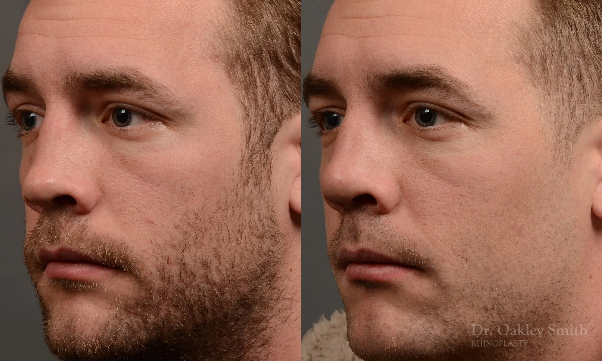 388D-rhinoplasty-dr-oakley-smith-toronto-nose-job.jpg