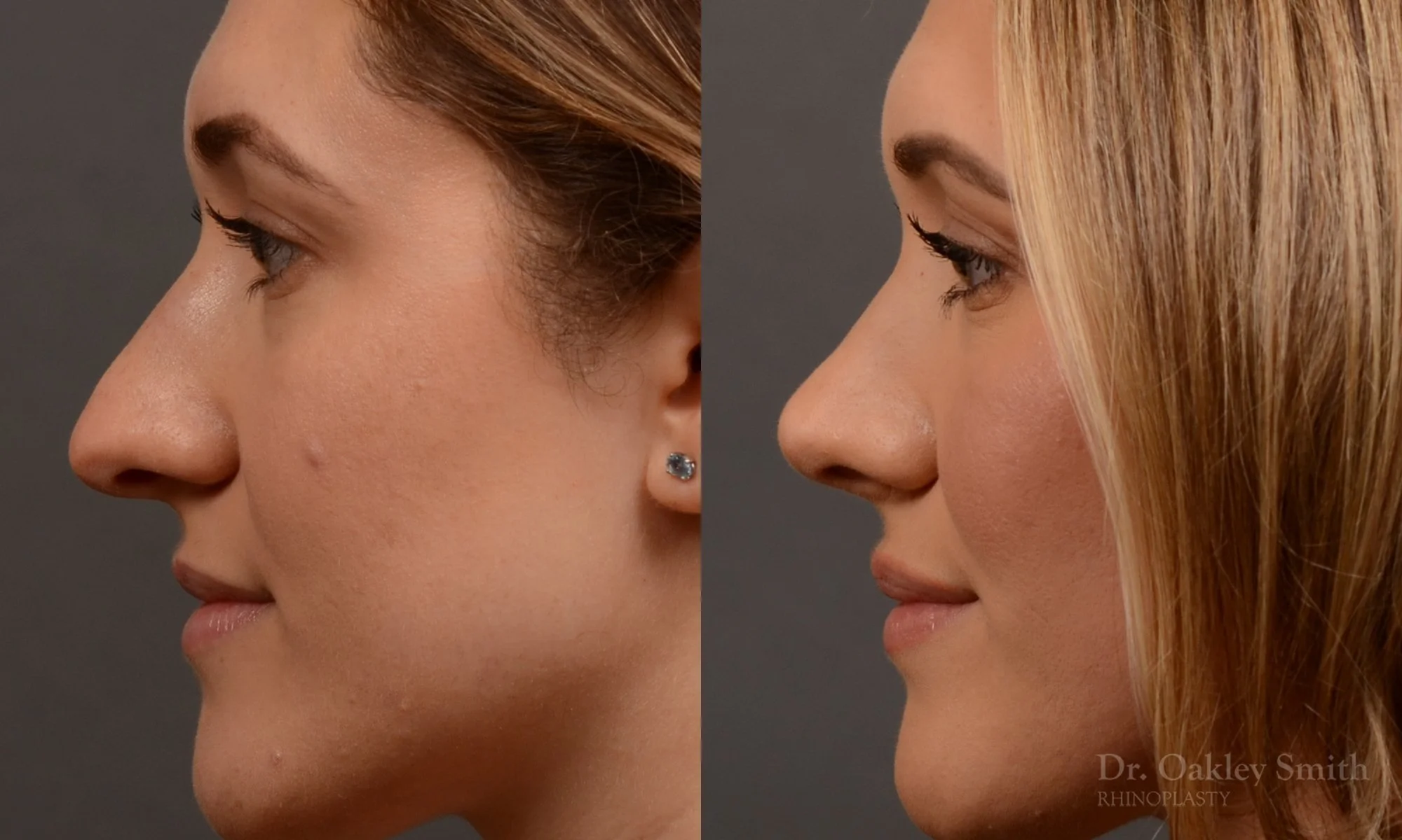 497E-rhinoplasty-dr-oakley-smith-toronto-top-surgeon-nose-job.jpg
