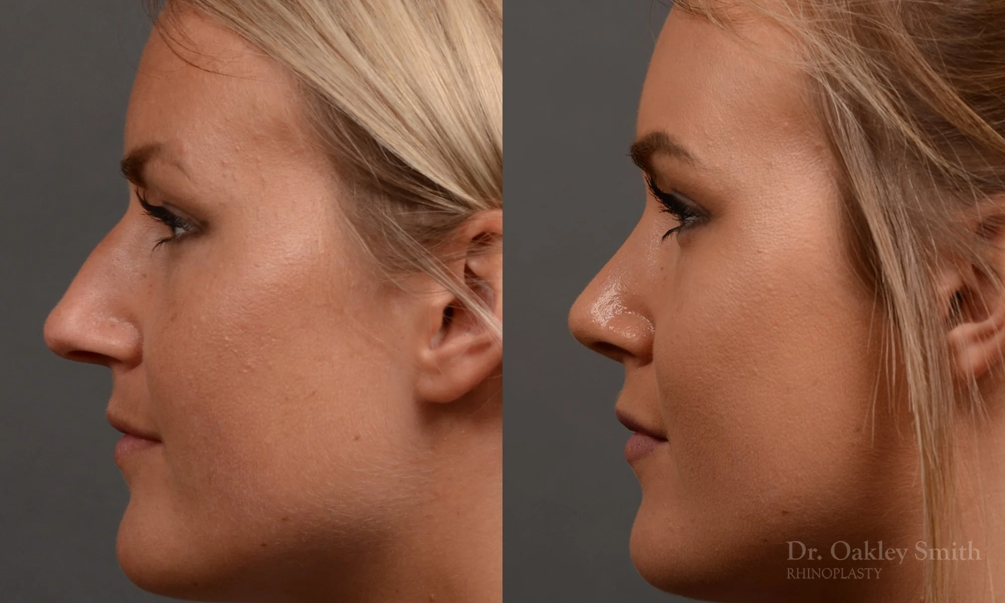 336E-rhinoplasty-dr-oakley-smith-toronto-nose-job.jpg