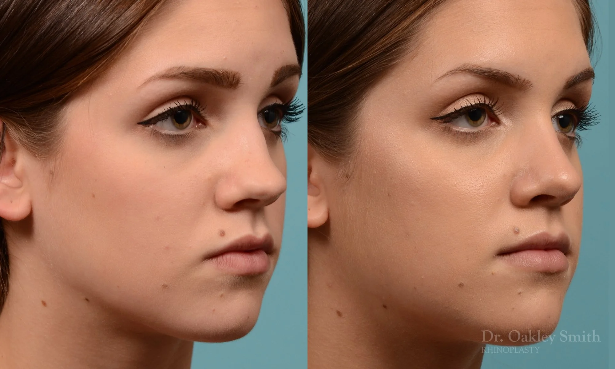 293B-rhinoplasty-dr-oakley-smith-toronto-nose-job.jpg