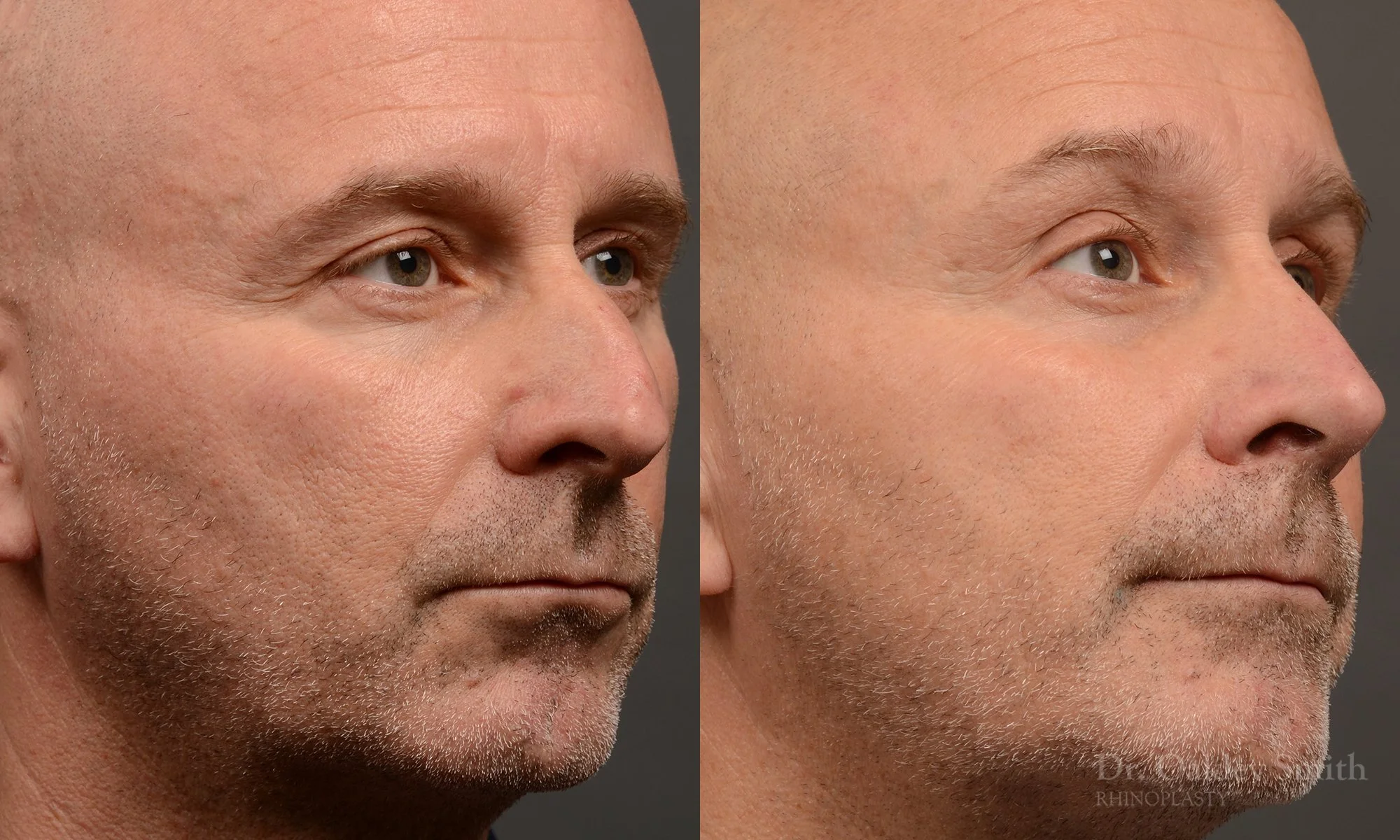 493B-male-rhinoplasty-dr-oakley-smith-toronto-top-surgeon-nose-job.jpg