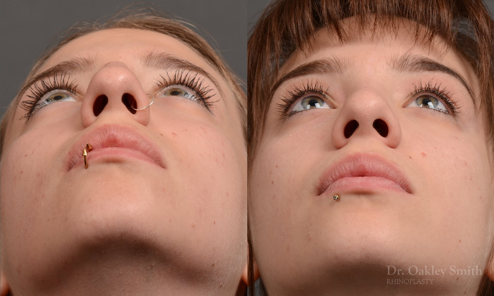 322.1F-Rhinoplasty-dr-oakley-smith-toronto-nose-job-.jpg