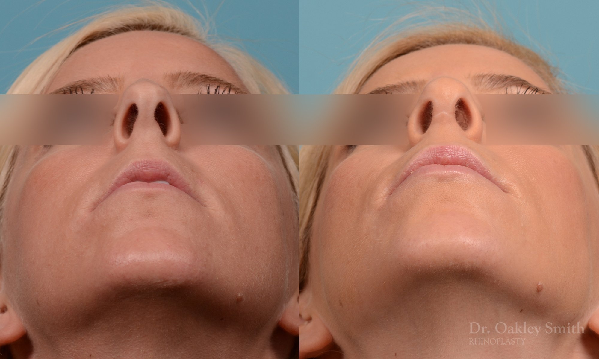 242F-rhinoplasty-dr-oakley-smith-toronto-nose-job-2.jpg
