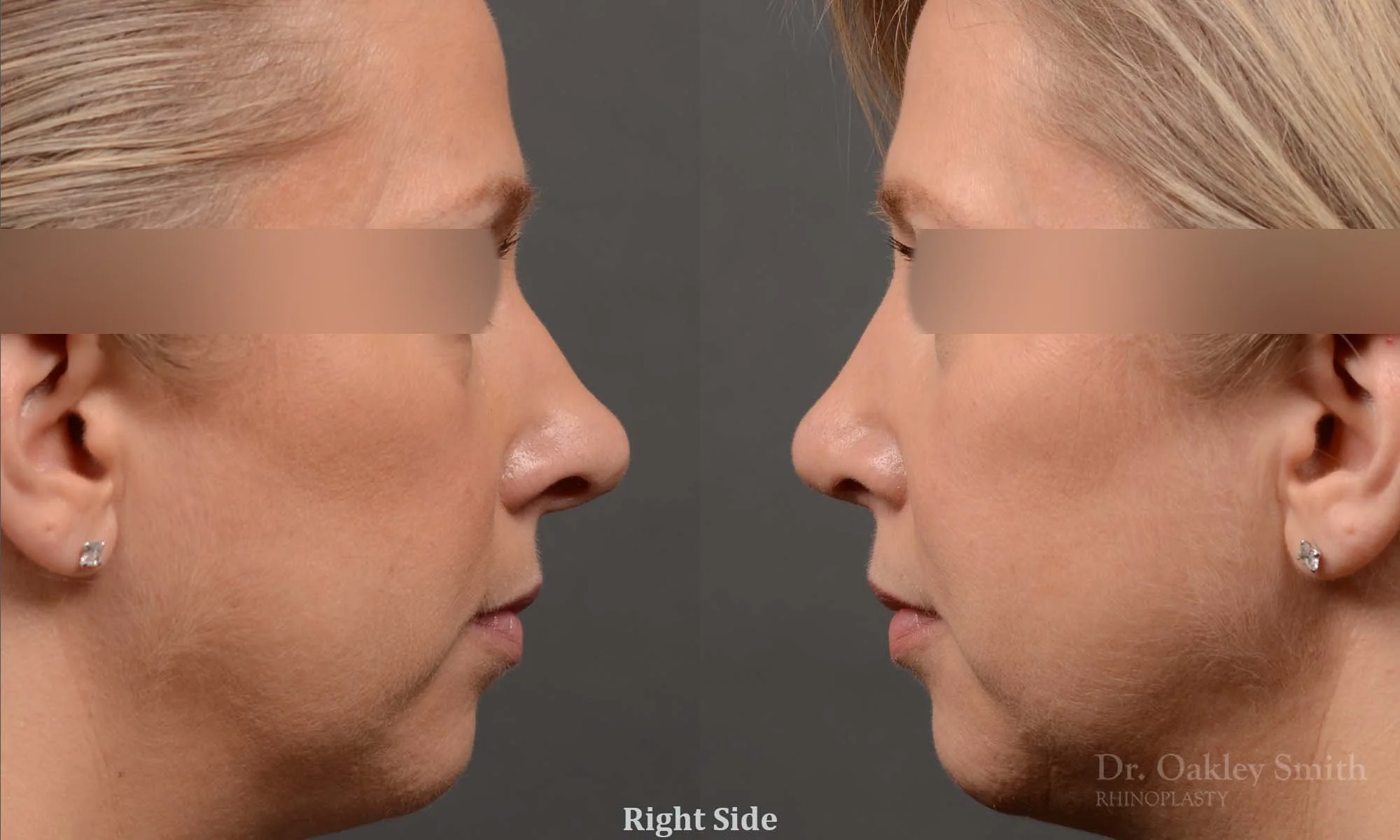 344: Female Rhinoplasty, Small Dorsal Hump, Tip Narrowing Refinement