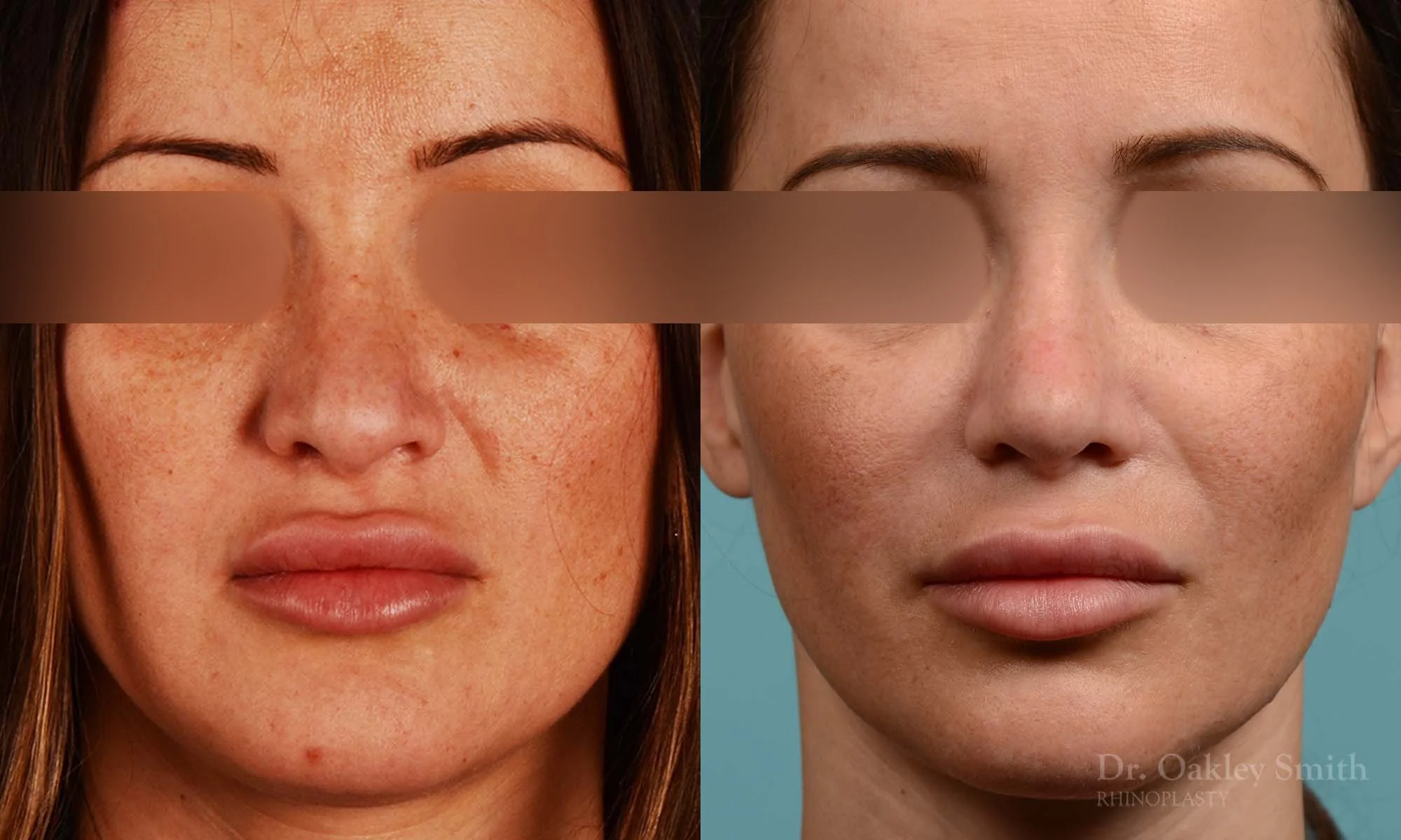 258A-rhinoplasty-dr-oakley-smith-toronto-nose-job.jpg