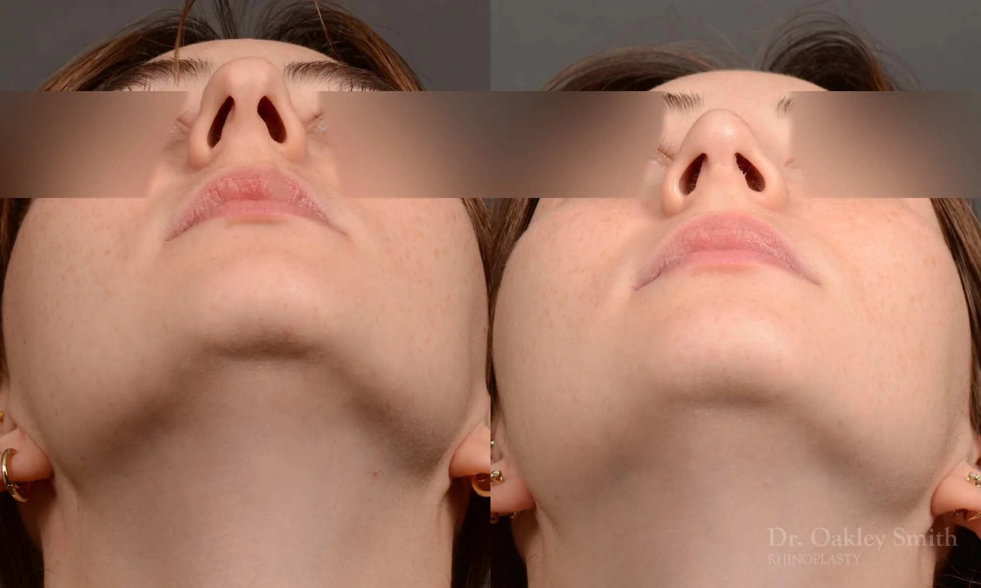 551F-rhinoplasty-nose-job-toronto-nose-surgeon-dr-oakley-smith.jpg