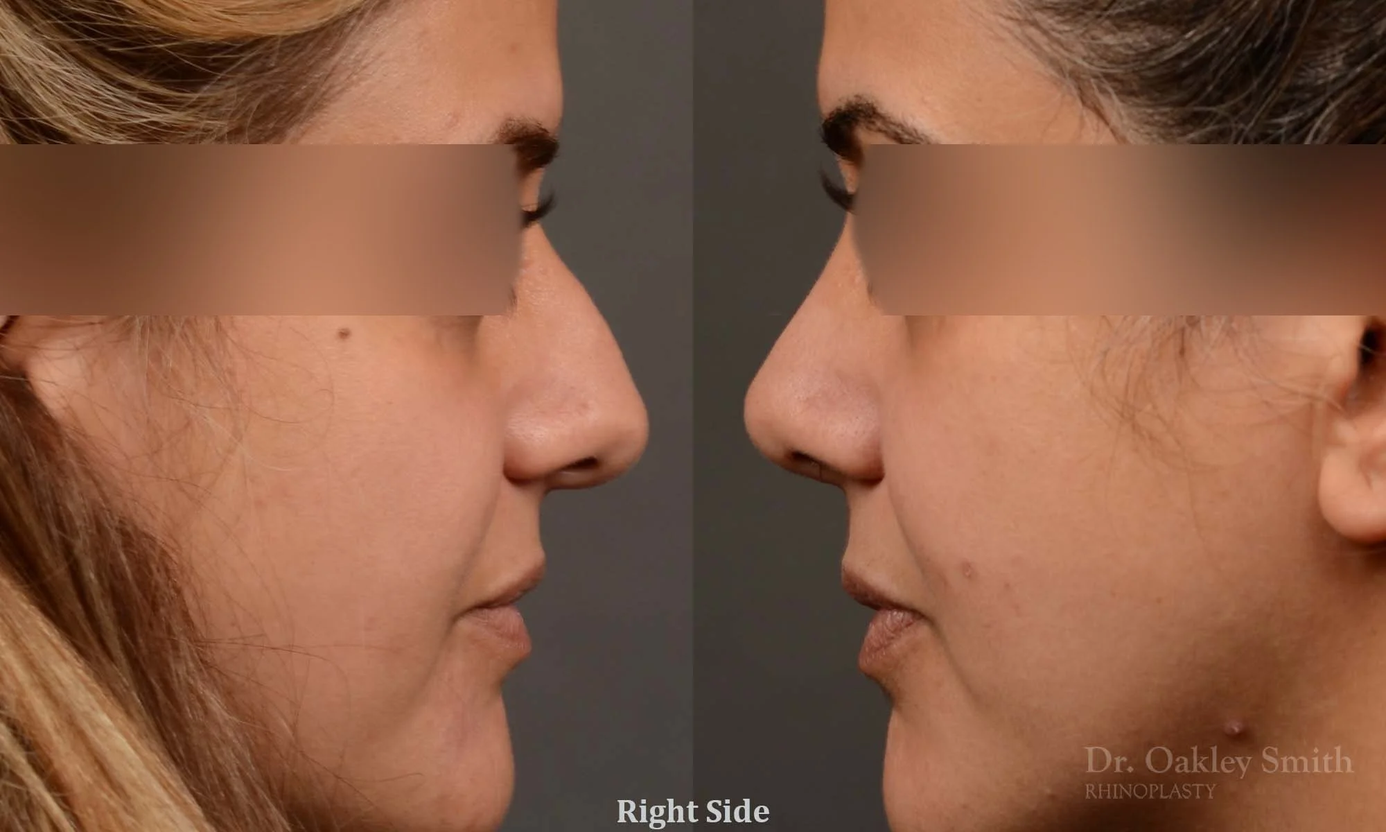 527: Female, Primary Rhinoplasty, Normal Skin, Bridge Work, Tip Work